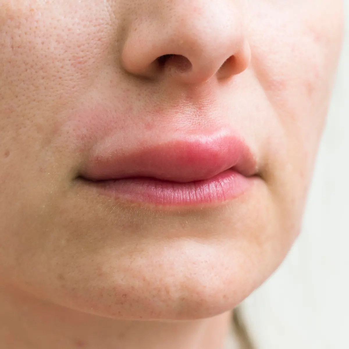 Quincke-Ödem (Angioödem) Logo von Quincke-Ödem (Angioödem)