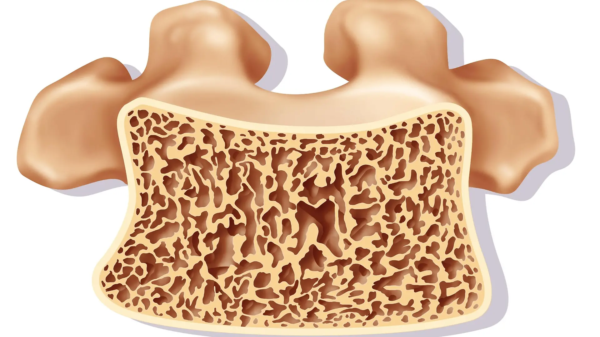 Dorsal vertebra affected by osteoporosis. The central part is composed of spongious tissue, partially destroyed, the peripheral part, clearer, of compact tissue. See images 1581007 for the healthy vertebra, 1581407 for the osteoporotic vertebra, 1581207 for the comparison of the two. | Verwendung weltweit, Keine Weitergabe an Wiederverkäufer.