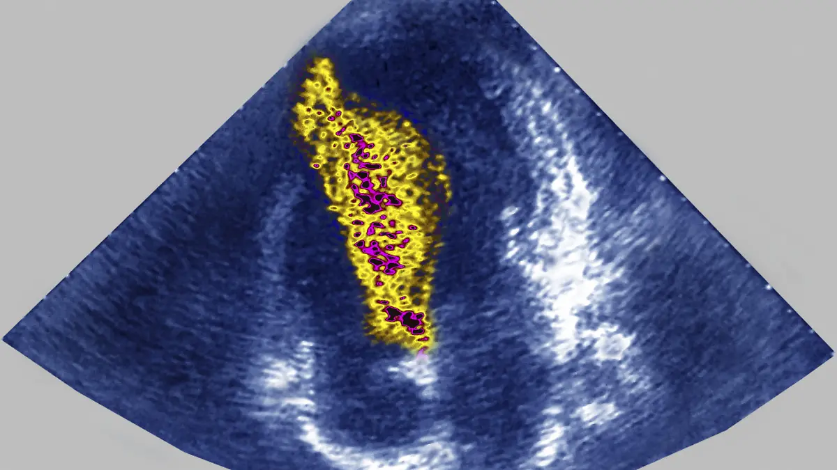 Kardiale Hypertrophie der Scheidewand