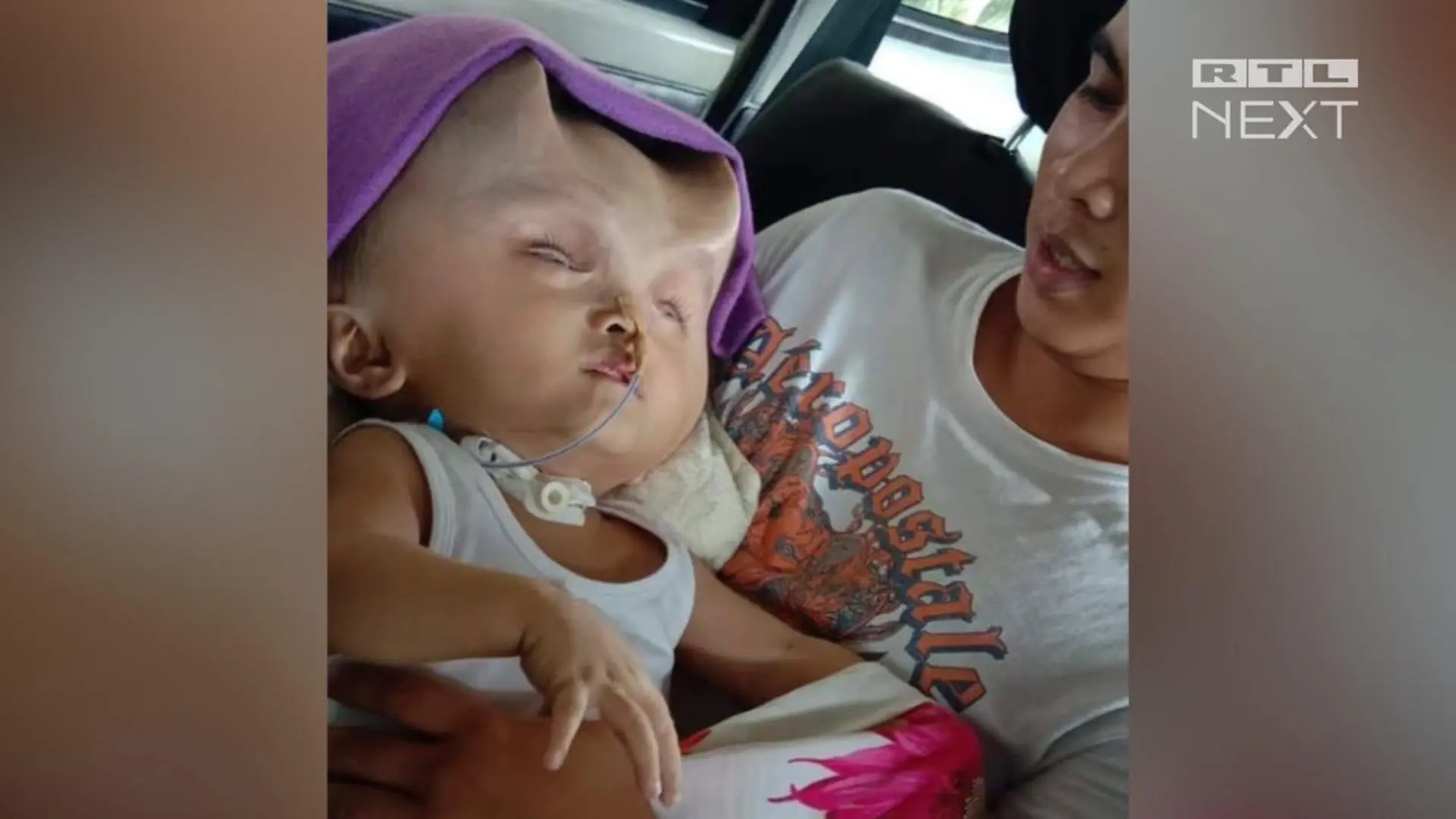 Clyne Solano leidet an Hydranencephalie, einer schweren Fehlbildung des Gehirns.