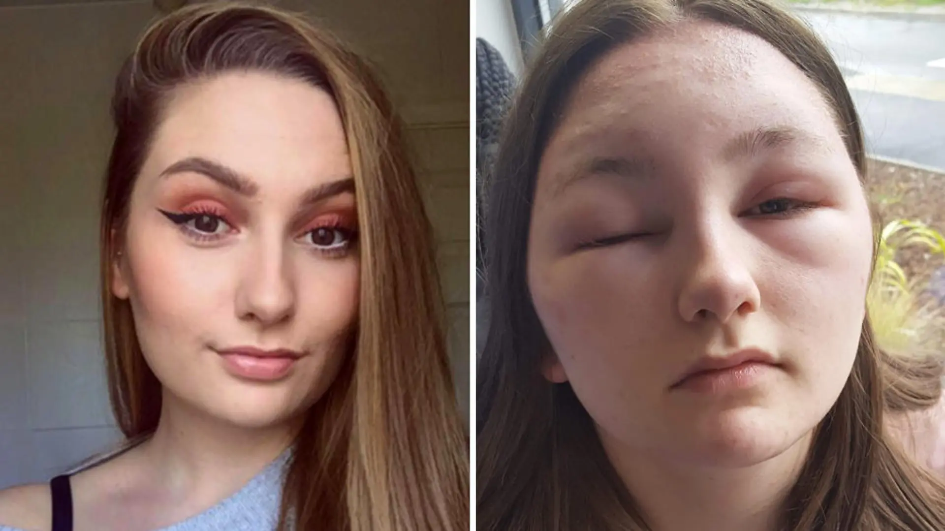 Riley O'Brien aus Colchester, England, erlitt wegen einer Haartönung einen allergischen Schock