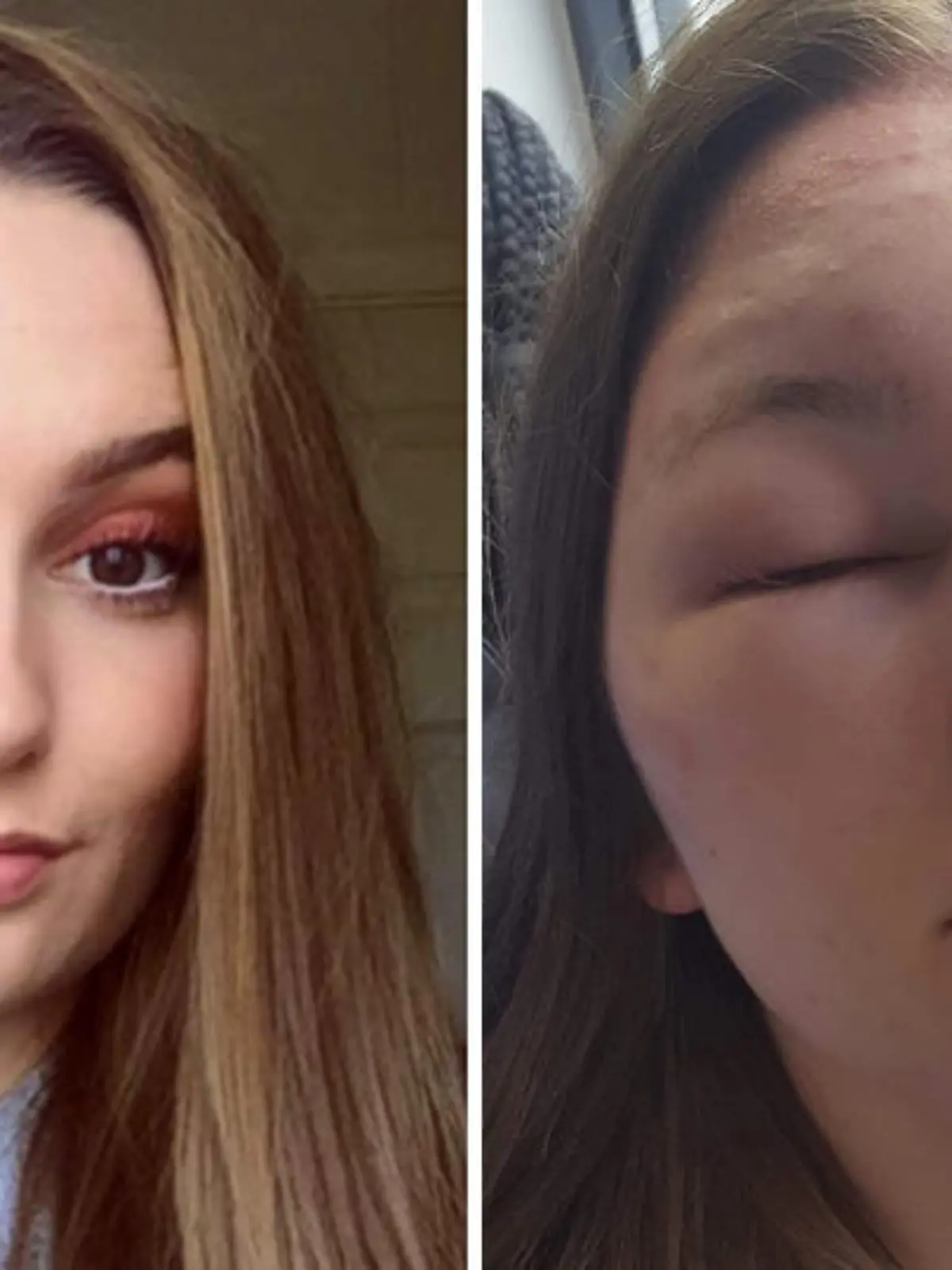 Riley O'Brien aus Colchester, England, erlitt wegen einer Haartönung einen allergischen Schock