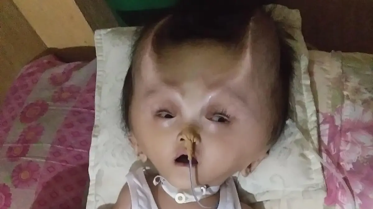 NEWS COPY - WITH VIDEO AND PICTURES

This toddlers battling a rare brain condition has been left with real-life DEVIL HORNS after a botched operation.

Twenty-two month old Clyne Solano suffered from congenital hydranencephaly in the womb which prevented his brain from developing fully.

Clyne's mother Justine Gatarin, 21, gave birth in January 2017 and immediately noticed the small cracks in the top of Clyne's skull. 

He underwent an operation for the condition in March this year to relieve swelling on the brain, which was a success. But the surgical procedure caused his skull to cave in to the holes in his head where brain tissue was missing. 

Since then the horn-like ridges have become more pronounced as his bones continue to grow. 

As well as battling hydranencephaly, Clyne also now needs reconstructive surgery to attempt to return his head to a normal shape. 

But his mother Justine is afraid of putting him through another operating in case he is not strong enough to survive.   SEE NEWS WIRE FOR FULL COPY