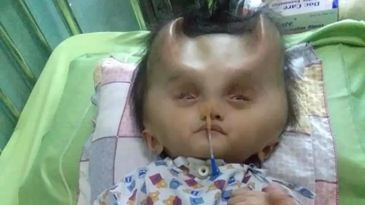 NEWS COPY - WITH VIDEO AND PICTURES

This toddlers battling a rare brain condition has been left with real-life DEVIL HORNS after a botched operation.

Twenty-two month old Clyne Solano suffered from congenital hydranencephaly in the womb which prevented his brain from developing fully.

Clyne's mother Justine Gatarin, 21, gave birth in January 2017 and immediately noticed the small cracks in the top of Clyne's skull. 

He underwent an operation for the condition in March this year to relieve swelling on the brain, which was a success. But the surgical procedure caused his skull to cave in to the holes in his head where brain tissue was missing. 

Since then the horn-like ridges have become more pronounced as his bones continue to grow. 

As well as battling hydranencephaly, Clyne also now needs reconstructive surgery to attempt to return his head to a normal shape. 

But his mother Justine is afraid of putting him through another operating in case he is not strong enough to survive.   SEE NEWS WIRE FOR FULL COPY
