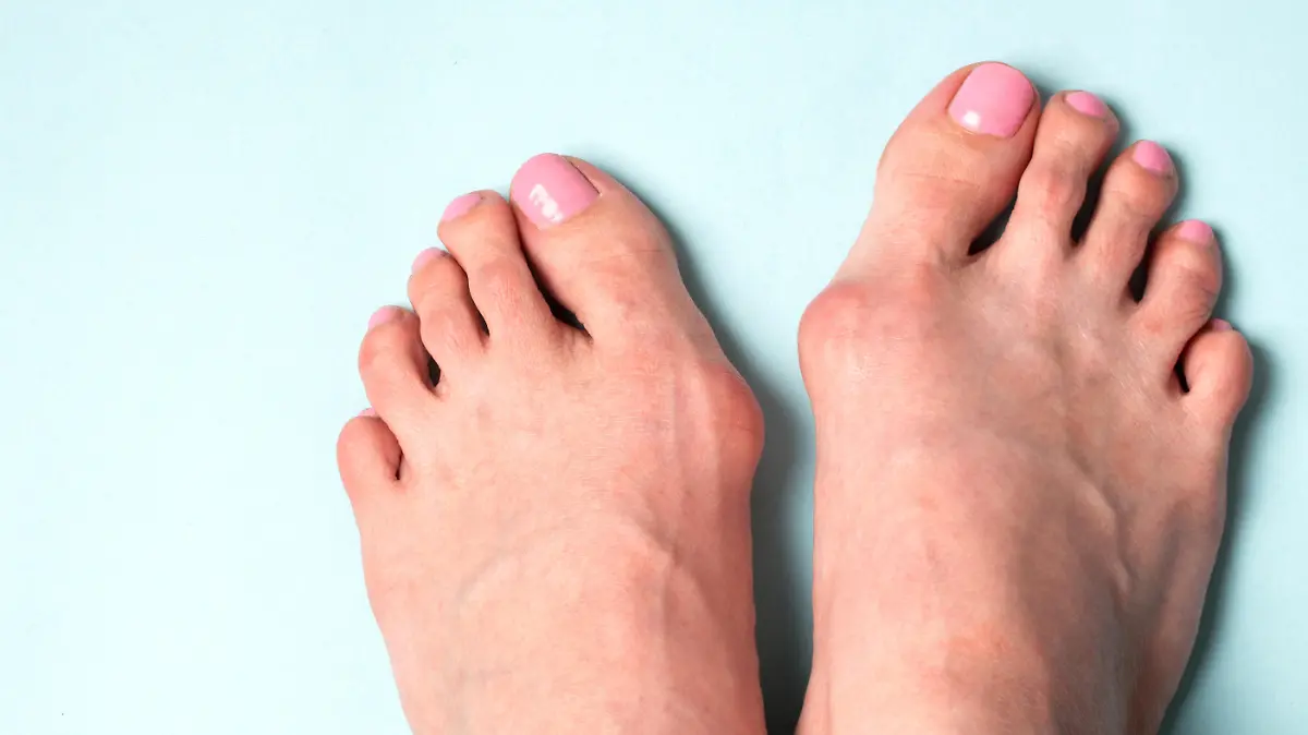 Ballenzeh Hallux Valgus