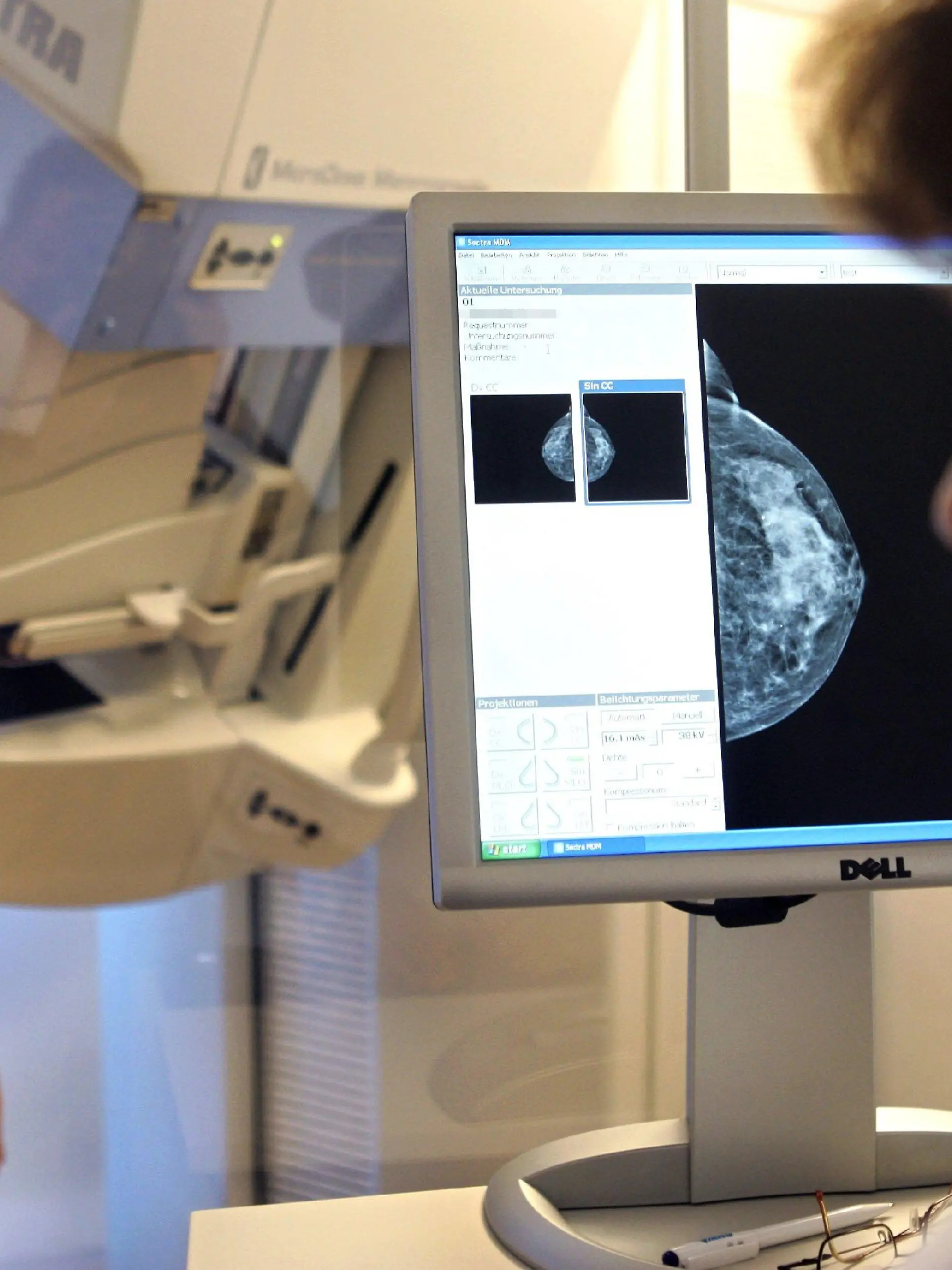 ARCHIV - Das Bild einer Mammografie ist in Münster auf einem Computermonitor zu sehen, während eine weitere Aufnahme mit dem Volldigitalen Scanverfahren vorbereitet wird (Archivfoto vom 24.10.2005). Die Gesundheitsreform bleibt in der Kritik der Krankenkassen, Verbände und Gewerkschaften. Heftig gestritten wurde über Änderungen bei der Krebsvorsorge und die Höhe der Zuzahlungen für Medikamente bei chronisch Kranken. Am Montag (16.10.2006) soll das Gesetz im Gesundheitsministerium mit den Verbänden erörtert werden. Foto: Bernd Thissen dpa/lnw +++(c) dpa - Bildfunk+++