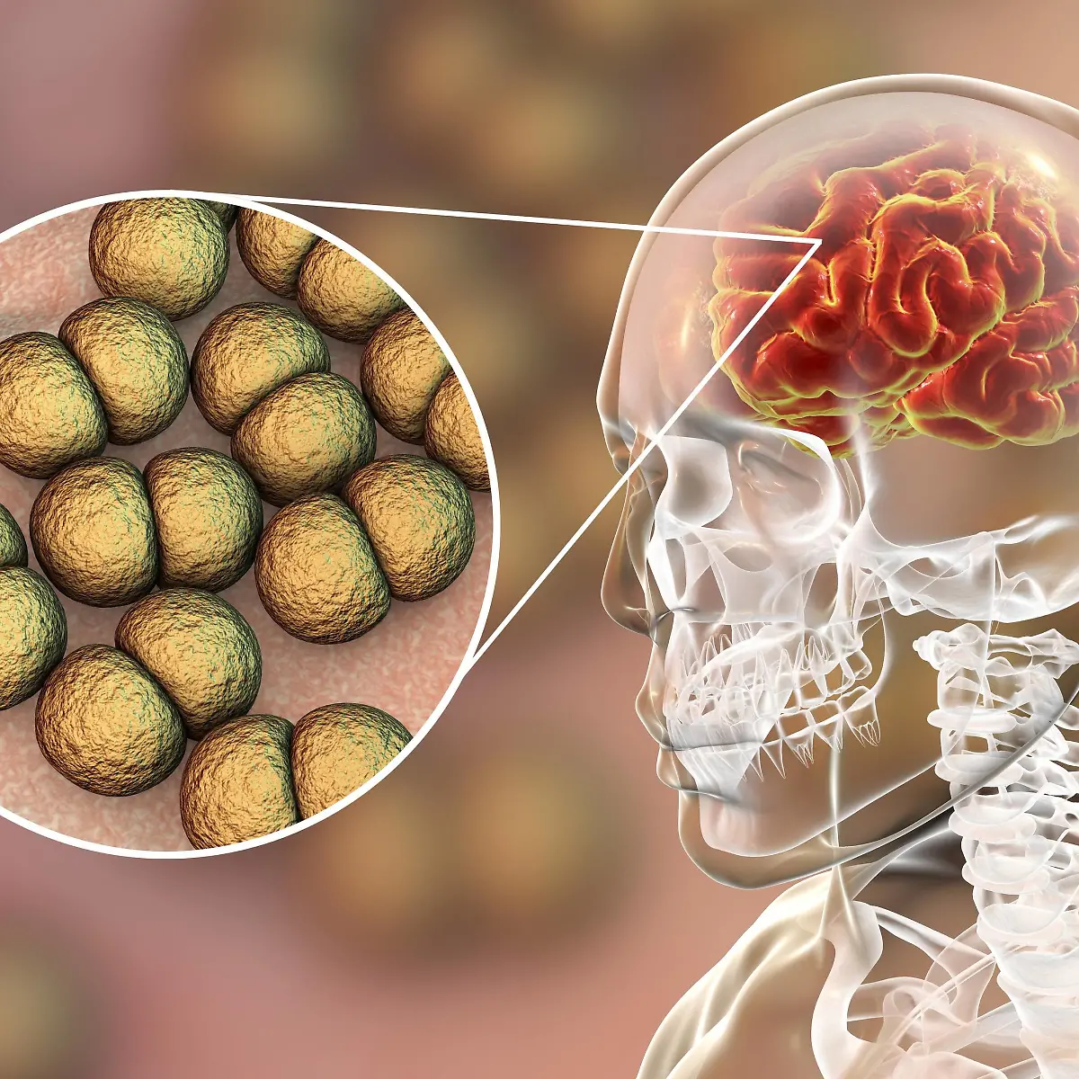 Hirnhautentzündung (Meningitis) Logo von Hirnhautentzündung (Meningitis)