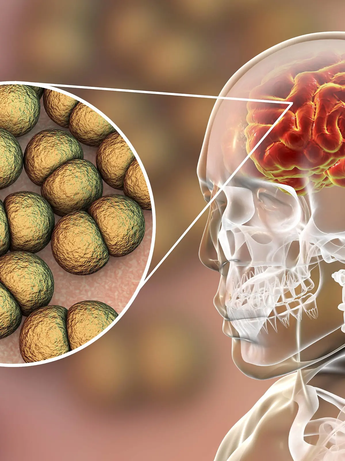 Neisseria meningitidis brain infection, illustration Neisseria meningitidis brain infection, computer illustration. N. meningitidis are gram-negative diplococci (spherical bacteria arranged in pairs), transmitted via the respiratory route. In most people they cause either asymptomatic infections or non-severe nasopharingitis, but can also cause severe meningitis and generalised infection (meningococcaemia), particularly in children. Their surface is covered with pilli which take part in attachment of bacteria to cells and surfaces. PUBLICATIONxINxGERxSUIxHUNxONLY KATERYNAxKON/SCIENCExPHOTOxLIBRARY F022/2079  