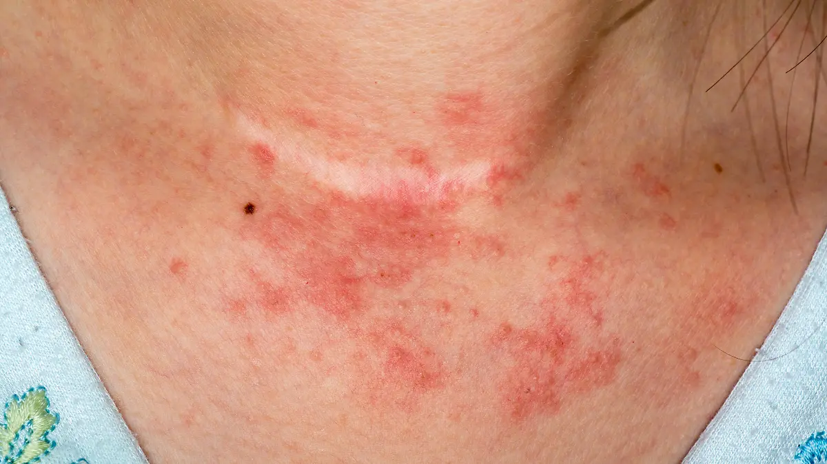 Frau mit Ausschlag auf Hals und Dekolleté