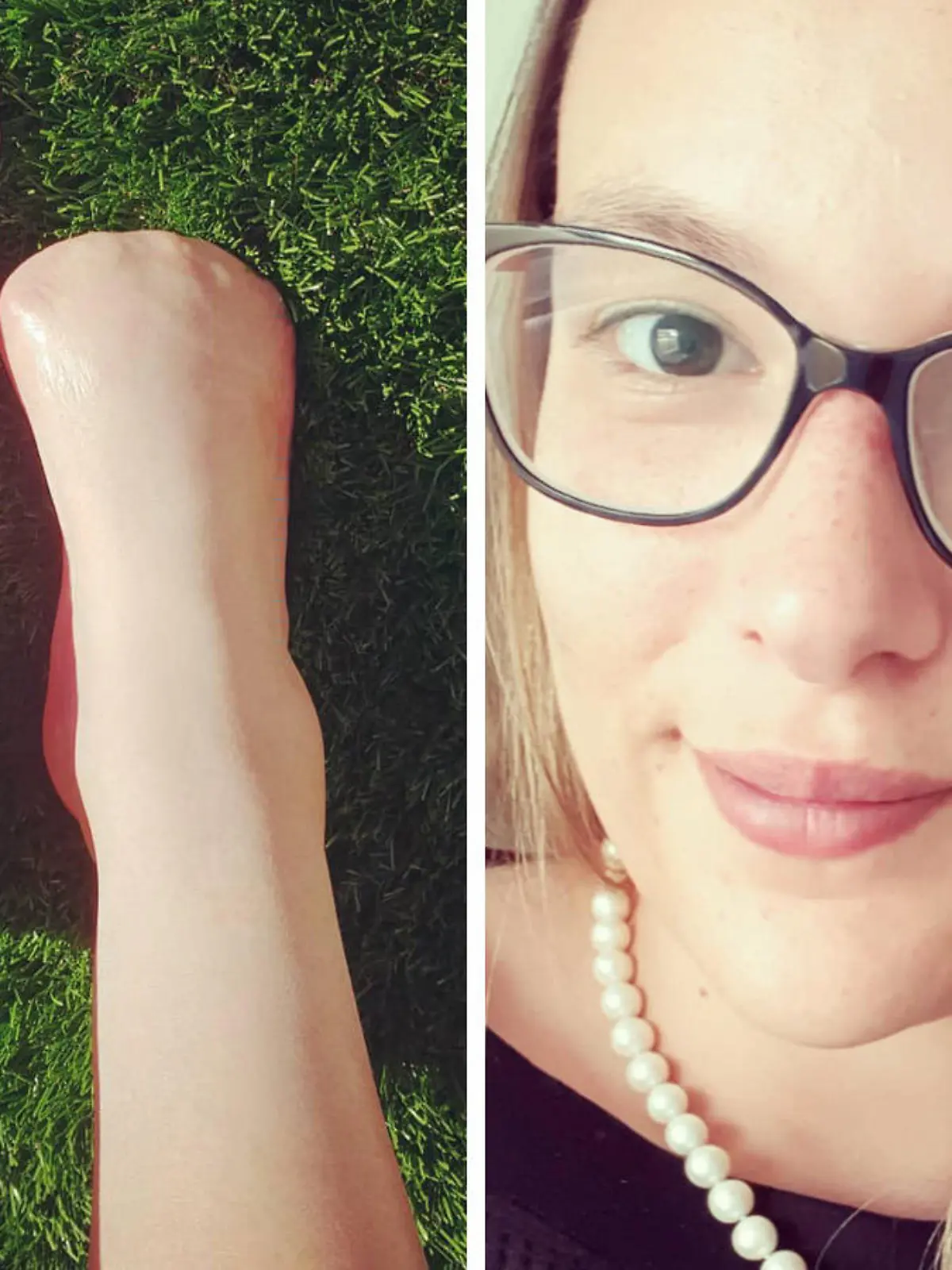 Victoria Curthoys: Links ihre Füße nach der Amputation, rechts die junge Australierin selbst
