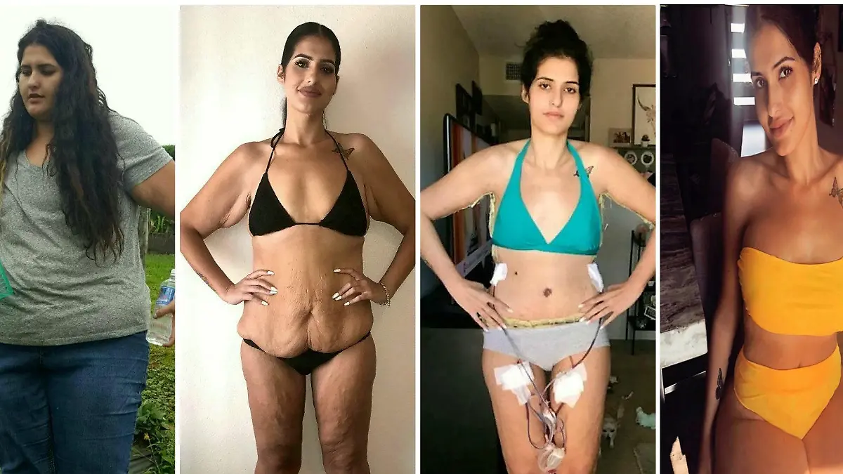 Shantel Carrillo nahm über 100 Kilogramm ab und ließ eine Hautstraffung vornehmen.