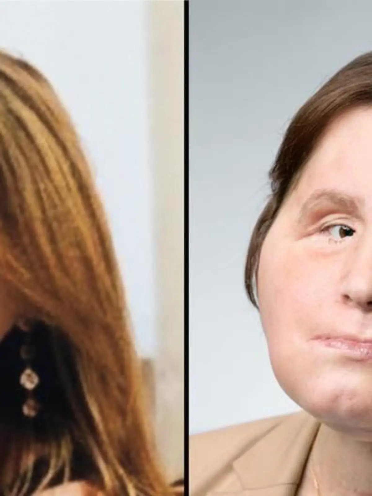Katie Stubblefield vor ihrem Selbstmordversuch und nach ihrer Gesichtstransplantation.