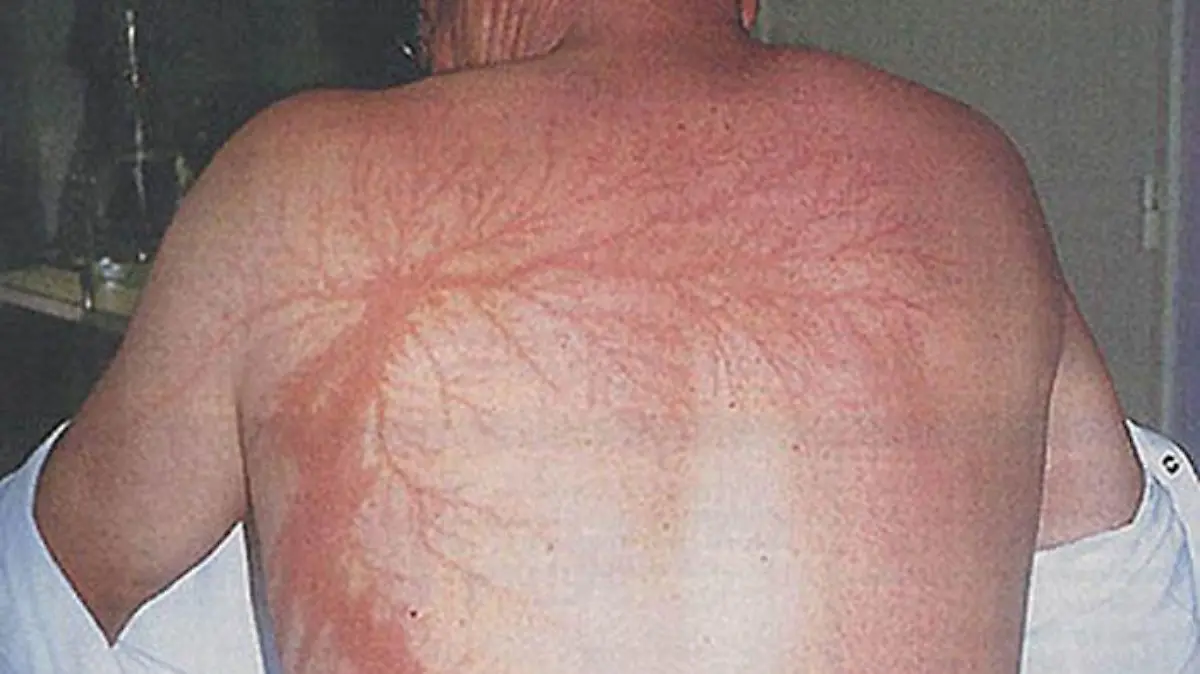 Die Lichtenberg-Figuren entstehen bei Blitzeinschlägen. Sie zeichnen die Blitz-Opfer fürs Leben.