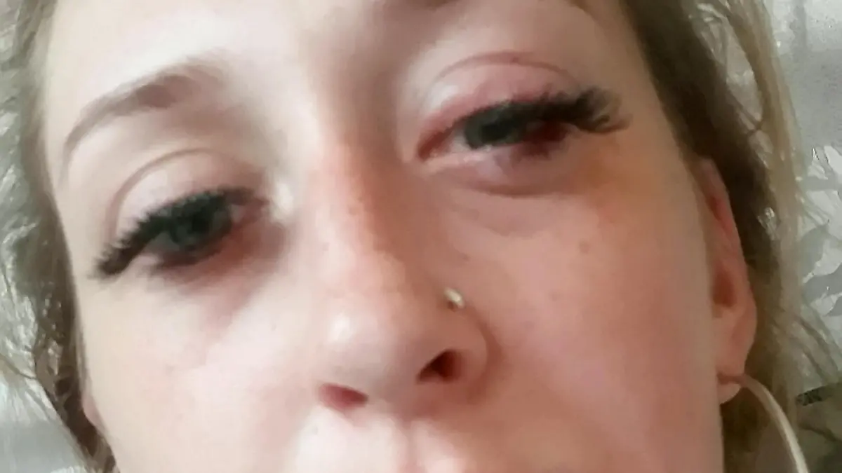 Der Wimpernkleber löste eine heftige allergische Reaktion aus.