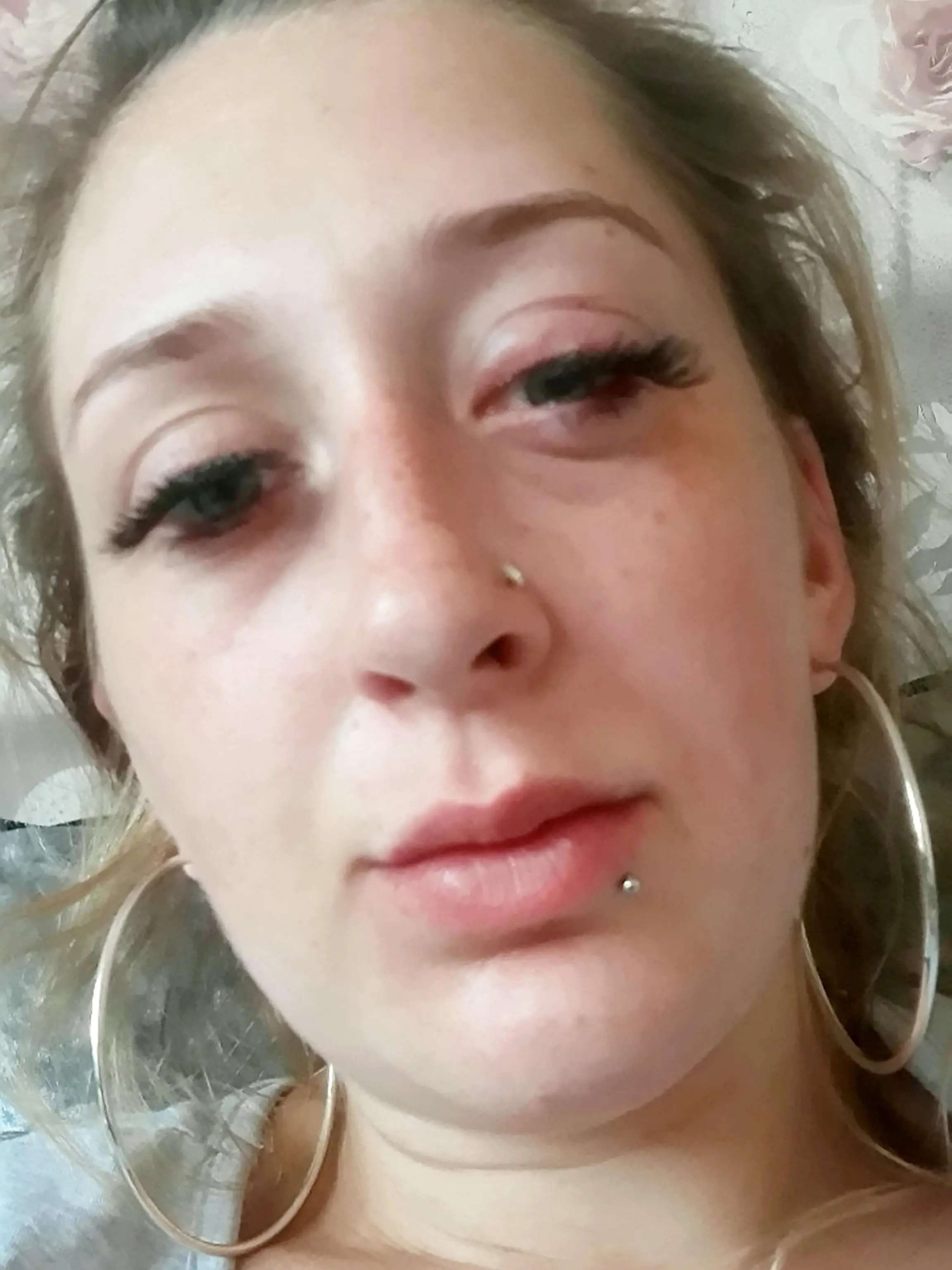 Der Wimpernkleber löste eine heftige allergische Reaktion aus.
