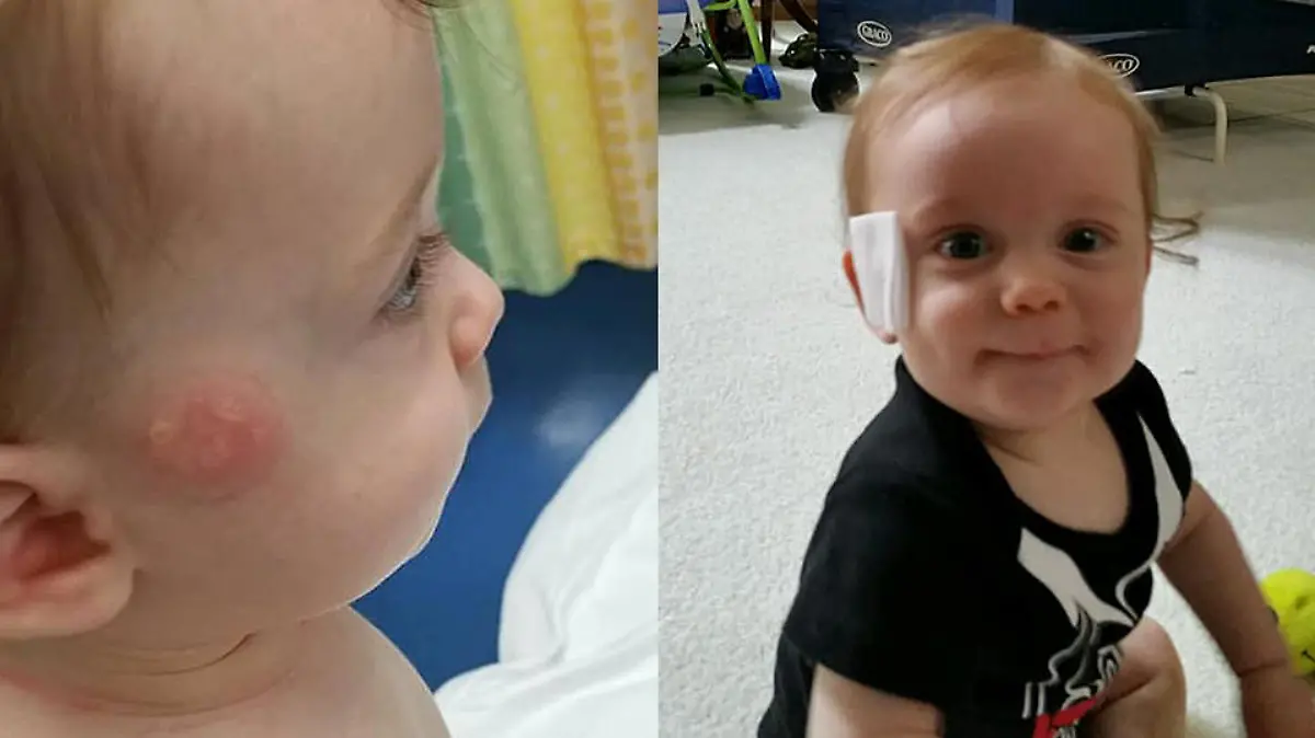 Baby Jack aus Michigan erlitt Brandblasen, weil sich sein Schnuller nachts an seiner Wange festsaugte. Jetzt warnt die Mutter andere Eltern auf Facebook.