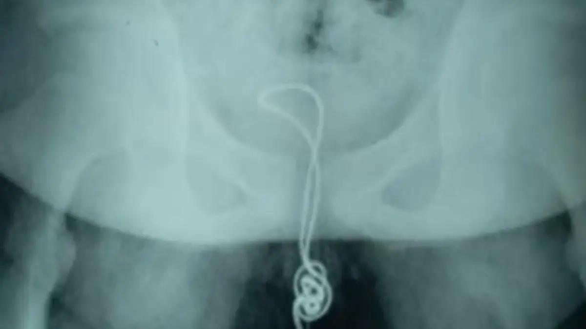 Röntgenbild: USB-Kabel in Penis