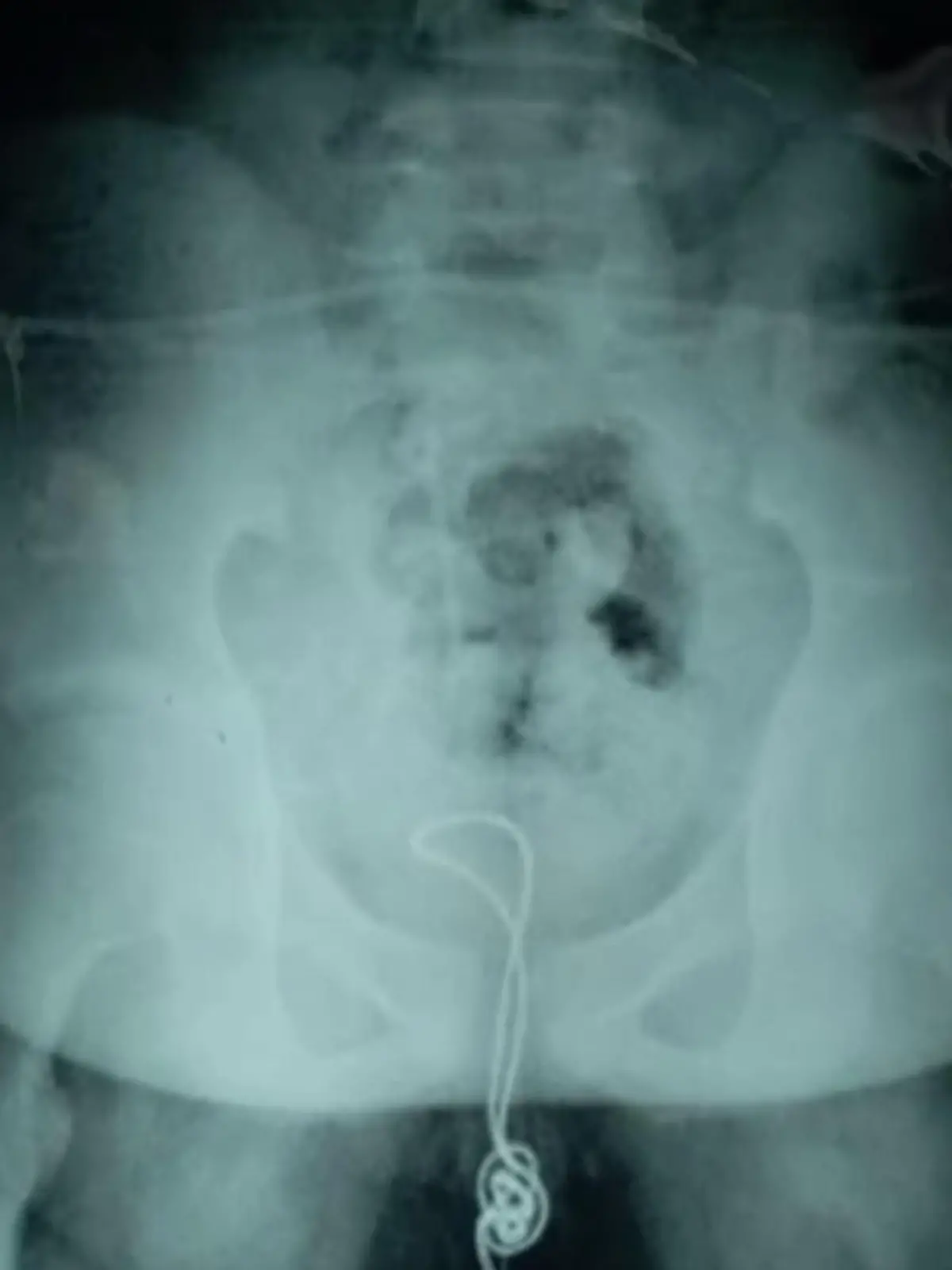 Röntgenbild: USB-Kabel in Penis