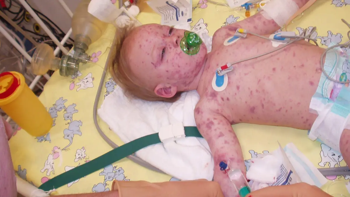 Mit zwei Jahren erkrankt Simon Seyfarth schwer an einer Meningokokken-Infektion. Die Eltern sagen: Die Diagnose kam zu spät. Doch das Gericht hat die Klage auf Entschädigung nun erneut zurückgewiesen.