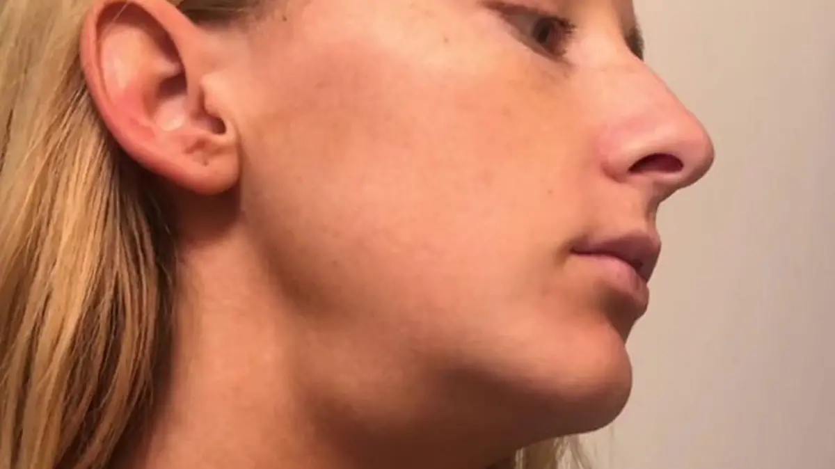 PIC FROM Kennedy News and Media (PICTURED: Helen Bender, 26, from Mobile Alabama, who discovered she had stage IV melanoma after using viral TikTok beauty tool) An estate agent claims a viral TikTok beauty massage hack saved her life - after discovering a lump on her neck that turned out to be CANCER. Helen Bender was using a popular gua shua massage tool on her face in a bid to sculpt a 'skinnier' jawline and soothe her neck muscles in April 2022, when she first felt the bump under her skin. Unfazed, the 26-year-old believed it to be a swollen lymph node caused by her being run down with a cold. DISCLAIMER: While Kennedy News and Media uses its best endeavours to establish the copyright and authenticity of all pictures supplied, it accepts no liability for any damage, loss or legal action caused by the use of images supplied and the publication of images is solely at your discretion. SEE KENNEDY NEWS COPY - 0161 697 4266