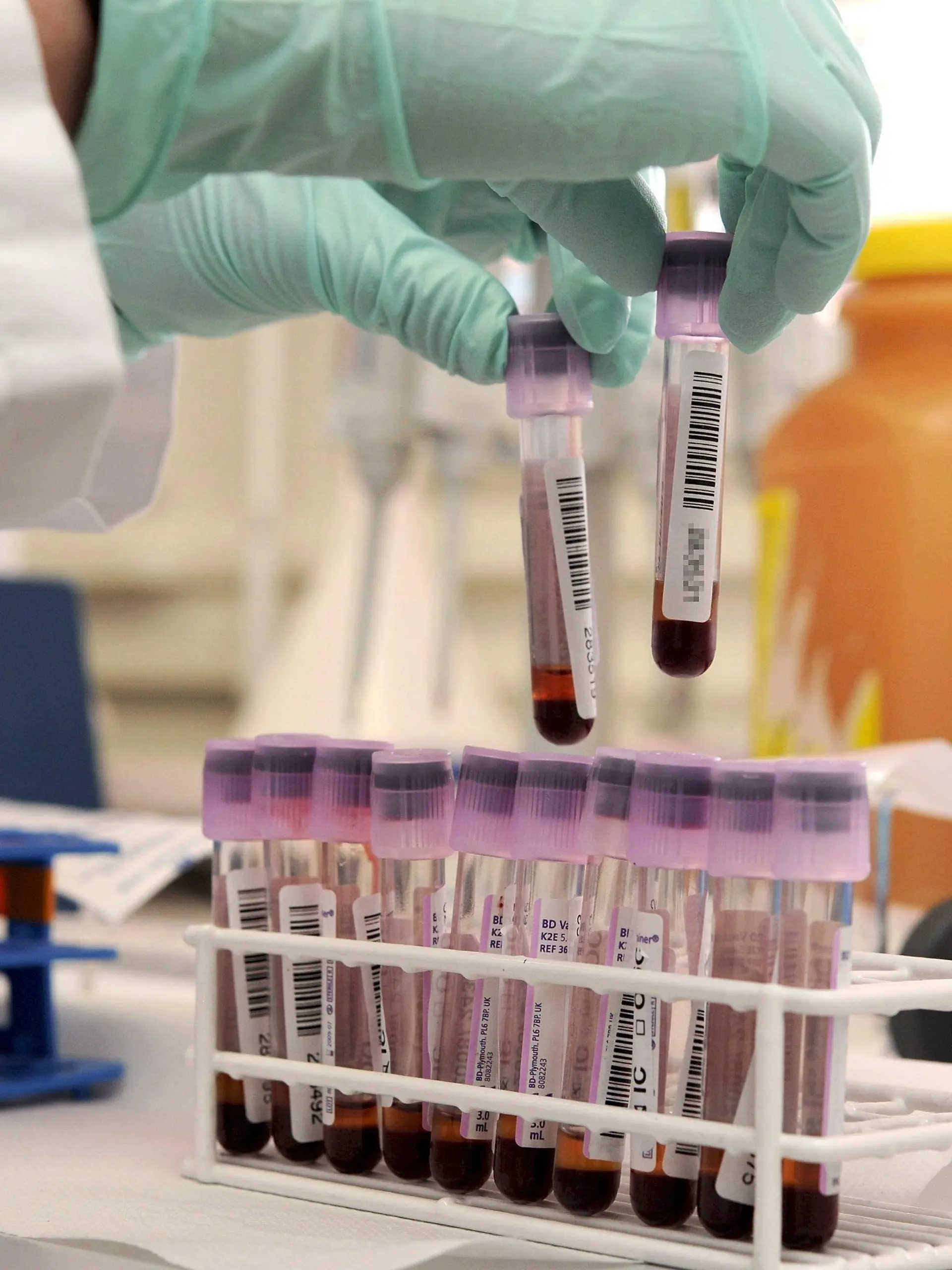 FILE - A laboratory assistant prepares blood to be tested for growth hormone and blood transfusion, at the Swiss Doping analysing laboratory in Lausanne, Switzerland on 10 June 2008. EPA/DOMINIC FAVRE (zu dpa «Doping-Namen bald öffentlich - Blutkontrollen in Fußball-Bundesliga» vom 09.08.2013) +++(c) dpa - Bildfunk+++