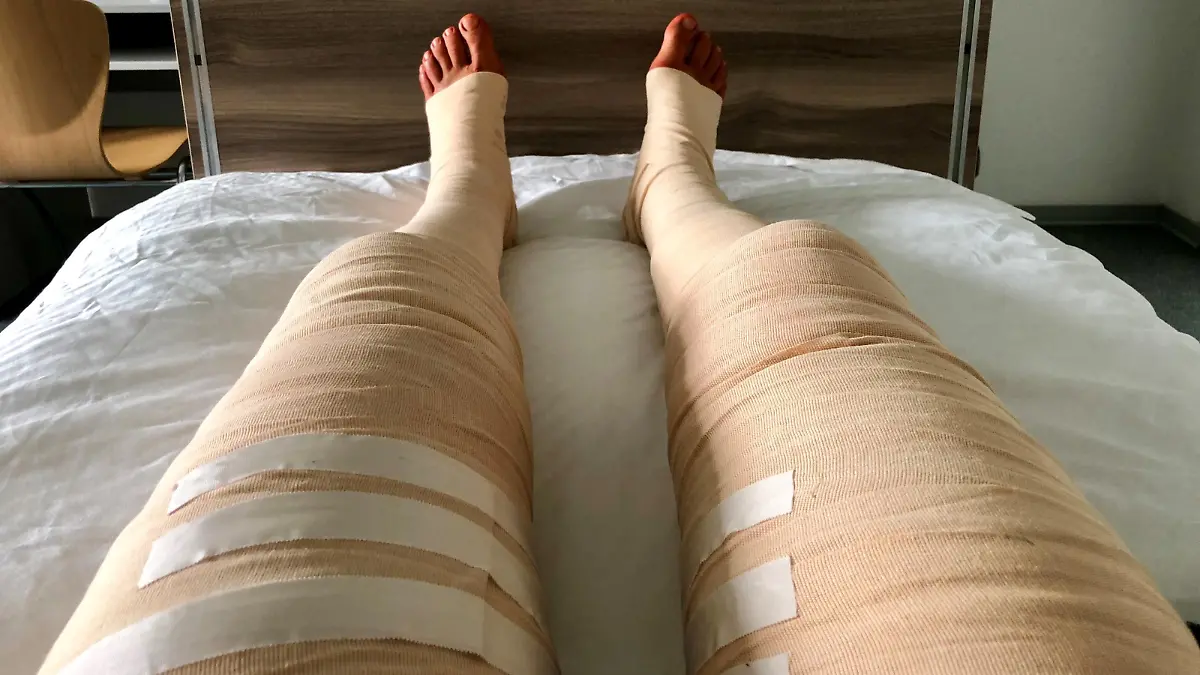 Die Krampfadern wurden bei Martin Hintzen gezogen