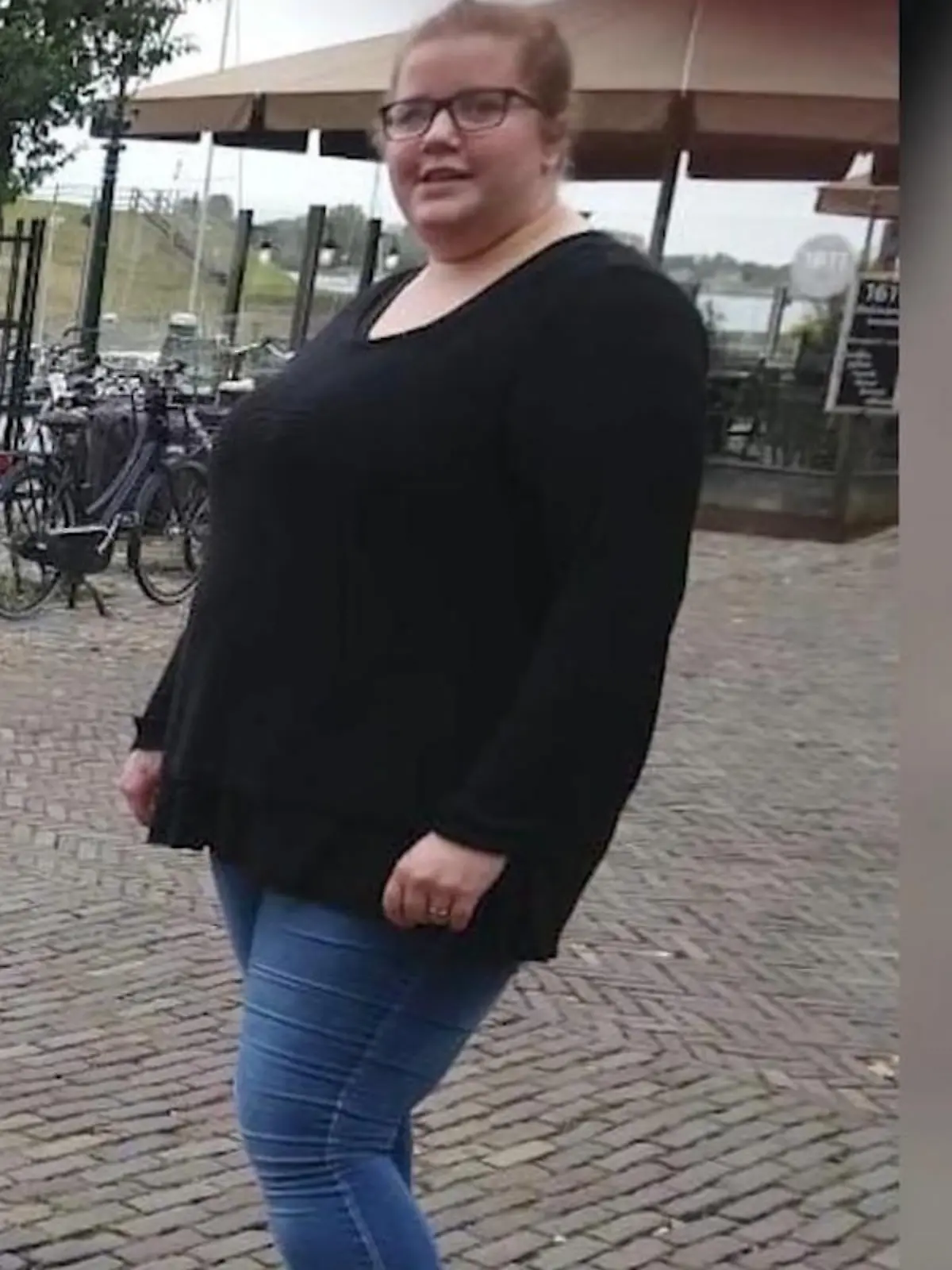 Bild zu: "Hautlappen-OP nach 75-Kilo-Abnahme!"