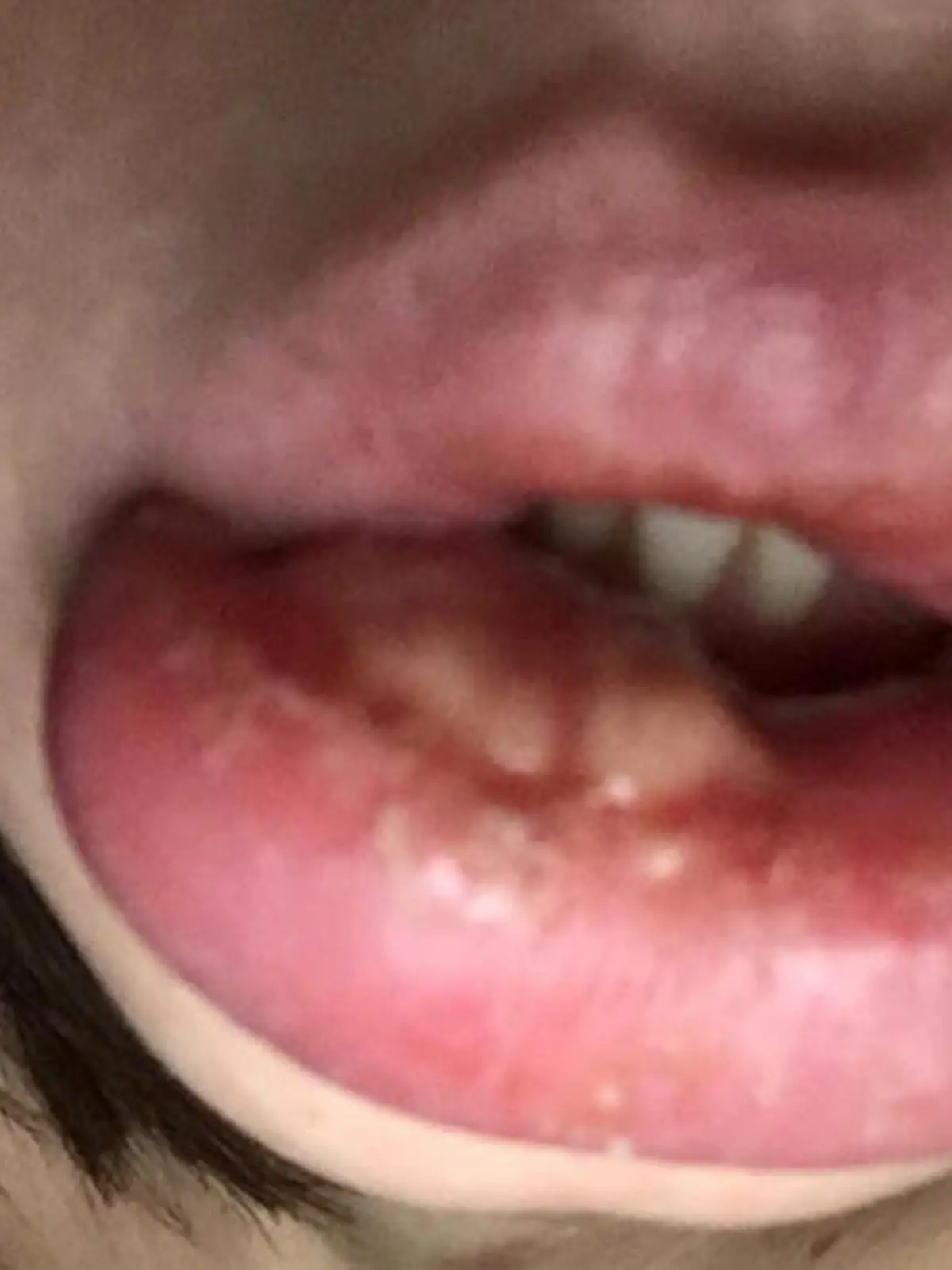 Sally Roberts will mit diesen Schockbildern vor Lippenaufspritzen warnen.