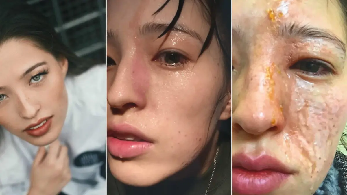 Eine Duftlampe hat Emilys Gesicht so verletzt So gefährlich können Raumduft-Diffuser sein