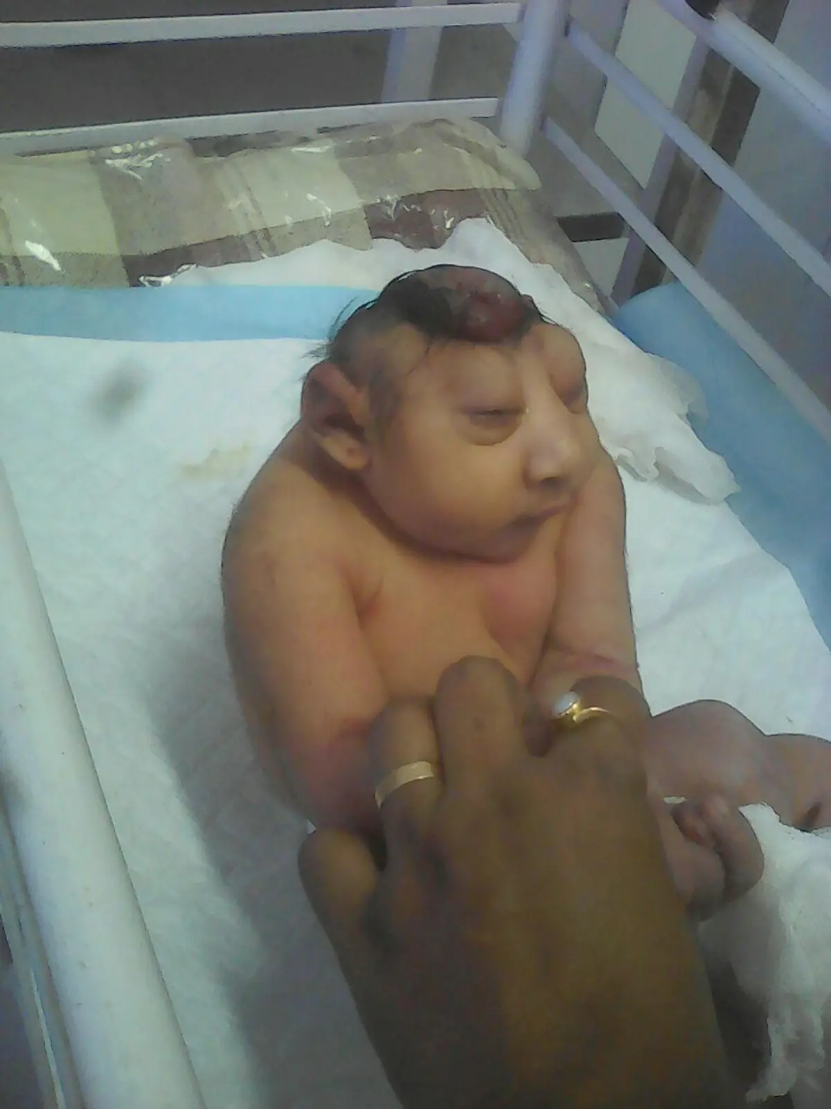Baby leidet unter Enzephalozele