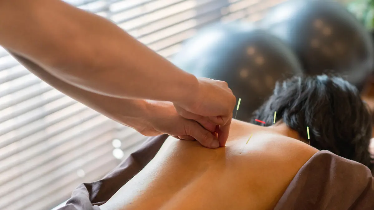Woman at the acupuncturist and doctor placing needles on her back - alternative medicine concepts