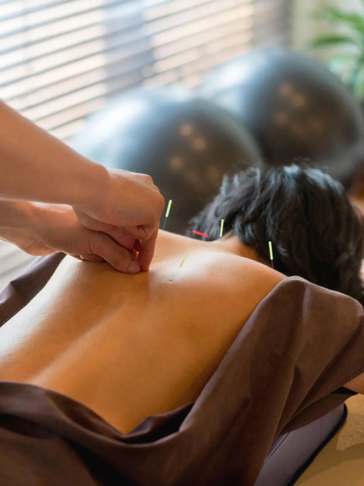Woman at the acupuncturist and doctor placing needles on her back - alternative medicine concepts