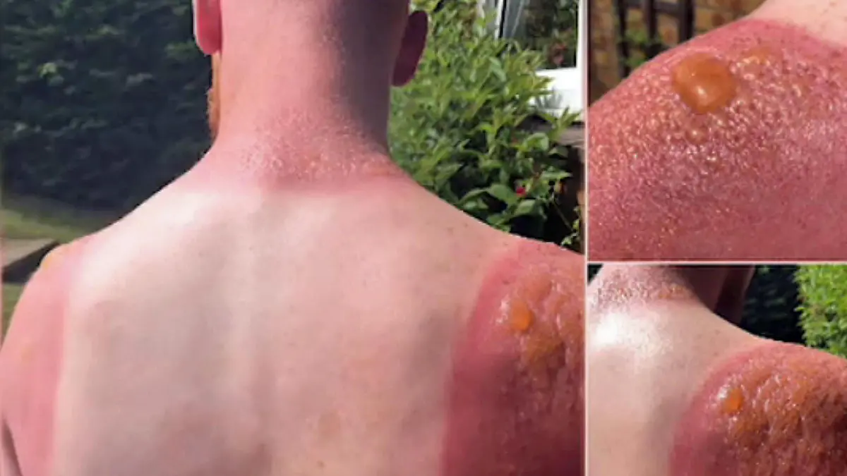 Sonnenbrand.jpg