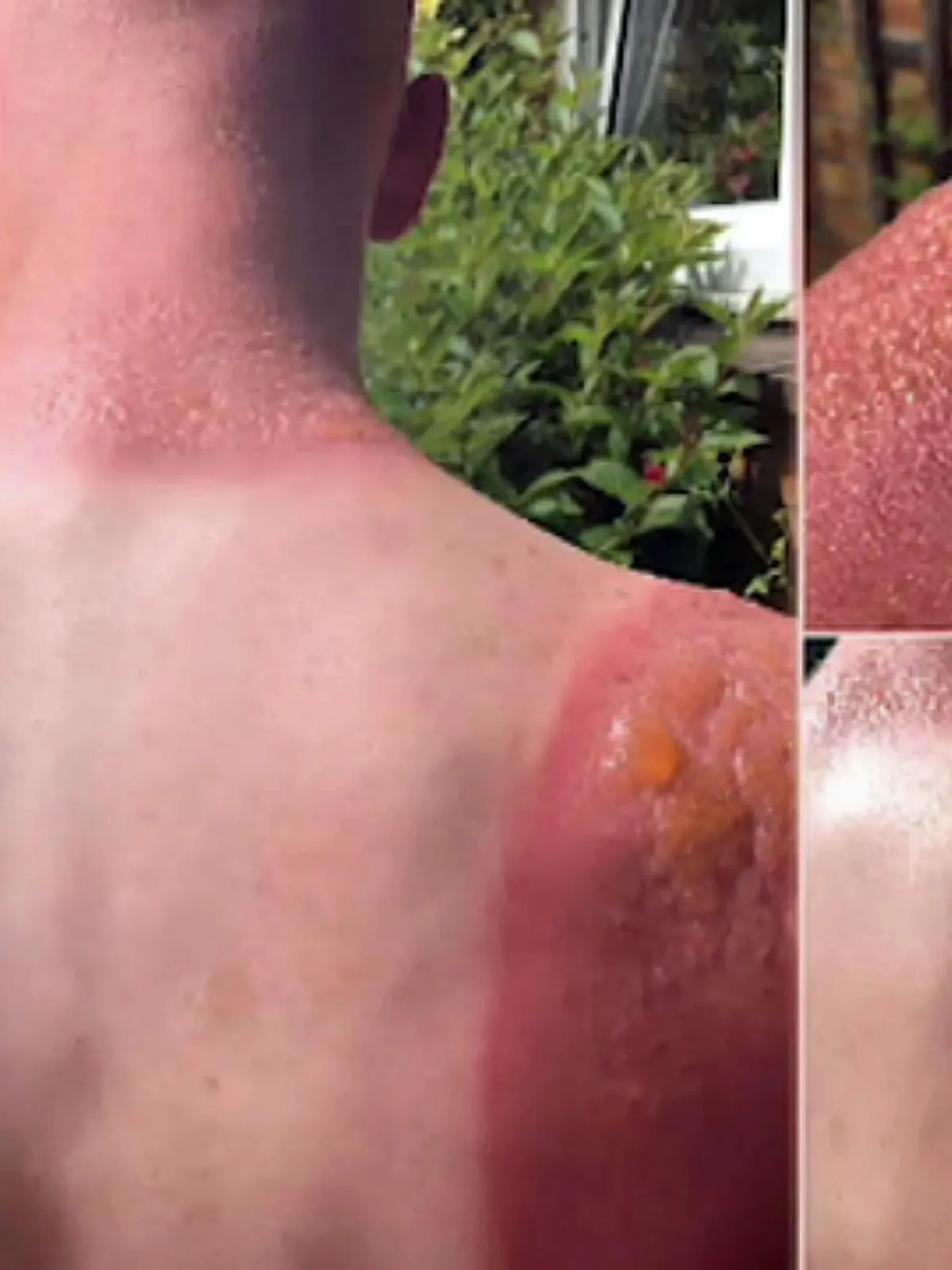 Sonnenbrand.jpg