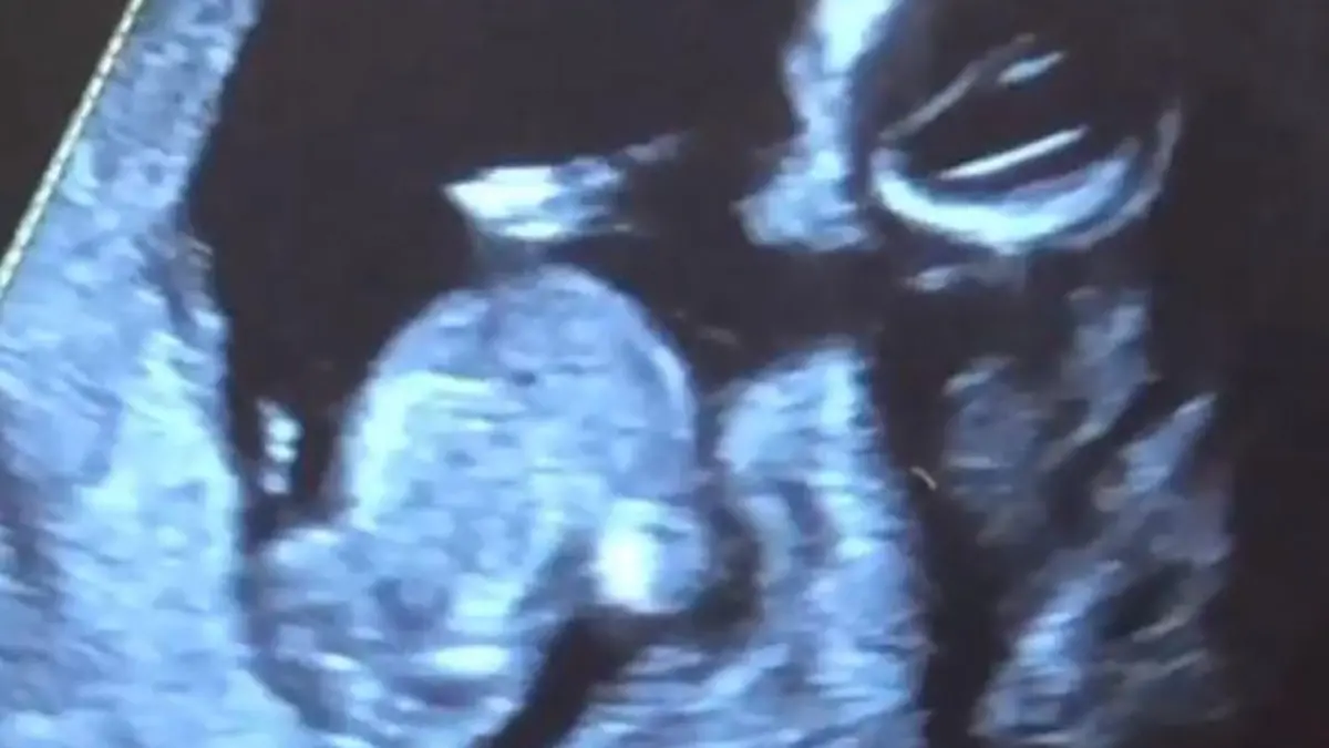 baby ultraschall