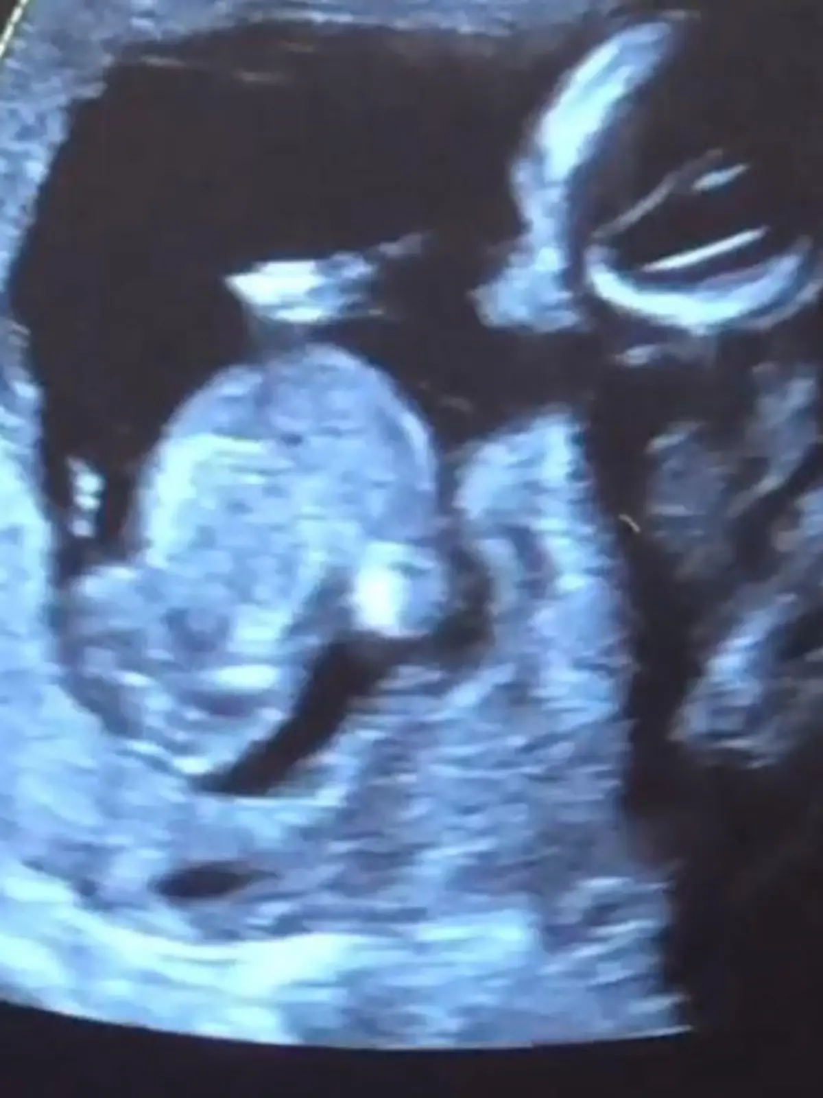 baby ultraschall