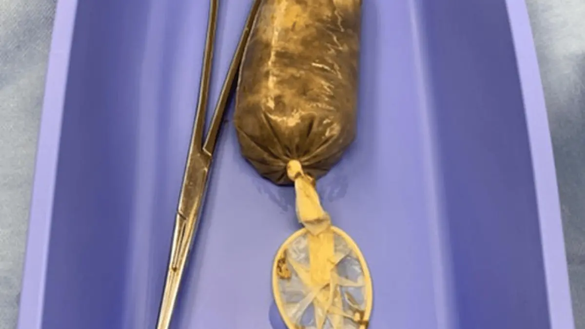 Story from Jam Press (Banana Condom Swallowed)

Pictured: The now removed banana-stuffed condom.

Man taken to hospital after eating a banana in a condom

A man was rushed to hospital after swallowing a banana in a CONDOM.

The unnamed victim had gulped the fruity contraceptive whole during a fit of rage.

The 34-year-old began vomiting and complained of stomach pains when he was rushed to hospital last year.

Doctors performed a CT scan where they found the slippery fruit lodged in his small intestine.

He had been unable to go to the loo for 24 hours as the fruit had been blocking his bowel.

The man was then rushed to surgery where doctors safely removed the banana.

Photos show the brown mushy filled condom beside the surgical scissors used to fish it out.

The man rested in hospital for three days before he was discharged.

It is believed to be the first case of an individual swallowing a banana in a condom.

This appeared in the Cureus Journal of Medical Science by radiologists Rosarie Tudas, Karan Rao, Yashant Aswani and surgeon Luis J. Garcia from the University of Iowa.

ENDS