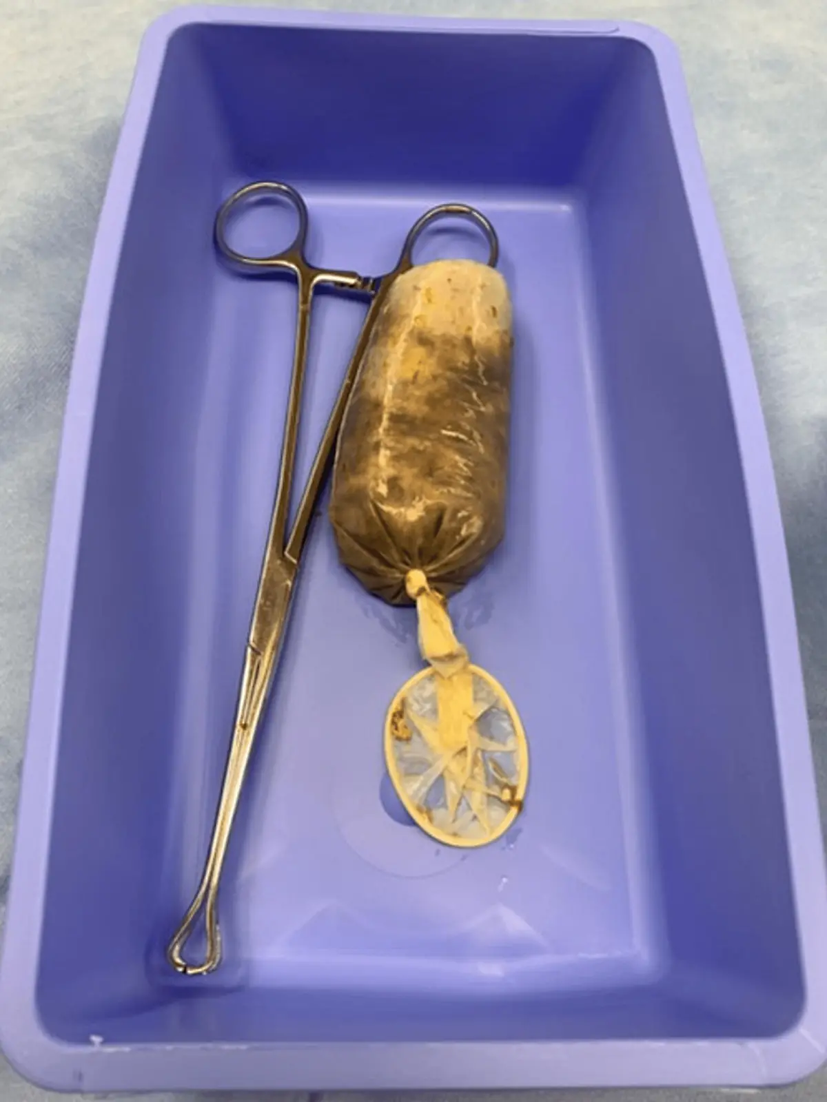 Story from Jam Press (Banana Condom Swallowed)

Pictured: The now removed banana-stuffed condom.

Man taken to hospital after eating a banana in a condom

A man was rushed to hospital after swallowing a banana in a CONDOM.

The unnamed victim had gulped the fruity contraceptive whole during a fit of rage.

The 34-year-old began vomiting and complained of stomach pains when he was rushed to hospital last year.

Doctors performed a CT scan where they found the slippery fruit lodged in his small intestine.

He had been unable to go to the loo for 24 hours as the fruit had been blocking his bowel.

The man was then rushed to surgery where doctors safely removed the banana.

Photos show the brown mushy filled condom beside the surgical scissors used to fish it out.

The man rested in hospital for three days before he was discharged.

It is believed to be the first case of an individual swallowing a banana in a condom.

This appeared in the Cureus Journal of Medical Science by radiologists Rosarie Tudas, Karan Rao, Yashant Aswani and surgeon Luis J. Garcia from the University of Iowa.

ENDS