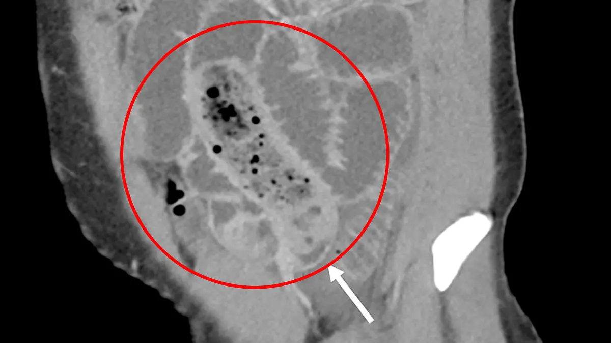 Story from Jam Press (Banana Condom Swallowed)

Pictured: Scans taken of the man's intestine after he swallowed a banana in a condom - Shows fecalization of the small bowel caused by the banana-stuffed condom

Man taken to hospital after eating a banana in a condom

A man was rushed to hospital after swallowing a banana in a CONDOM.

The unnamed victim had gulped the fruity contraceptive whole during a fit of rage.

The 34-year-old began vomiting and complained of stomach pains when he was rushed to hospital last year.

Doctors performed a CT scan where they found the slippery fruit lodged in his small intestine.

He had been unable to go to the loo for 24 hours as the fruit had been blocking his bowel.

The man was then rushed to surgery where doctors safely removed the banana.

Photos show the brown mushy filled condom beside the surgical scissors used to fish it out.

The man rested in hospital for three days before he was discharged.

It is believed to be the first case of an individual swallowing a banana in a condom.

This appeared in the Cureus Journal of Medical Science by radiologists Rosarie Tudas, Karan Rao, Yashant Aswani and surgeon Luis J. Garcia from the University of Iowa.

ENDS