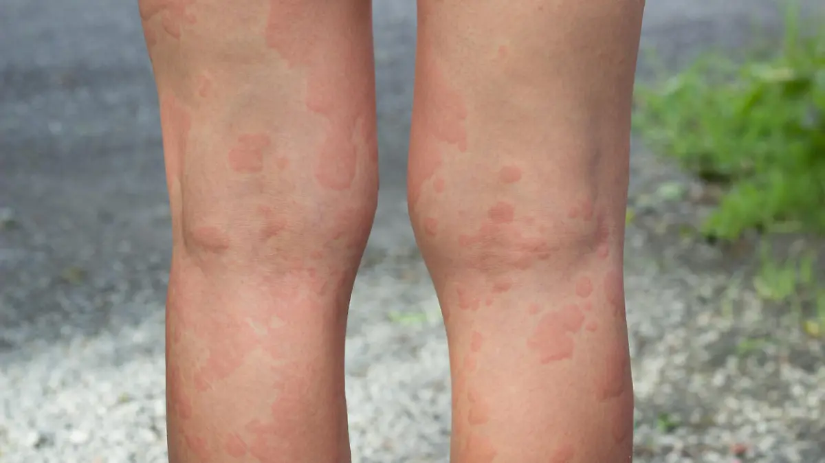 skin allergies, legs skin women.skin allergies, legs women.