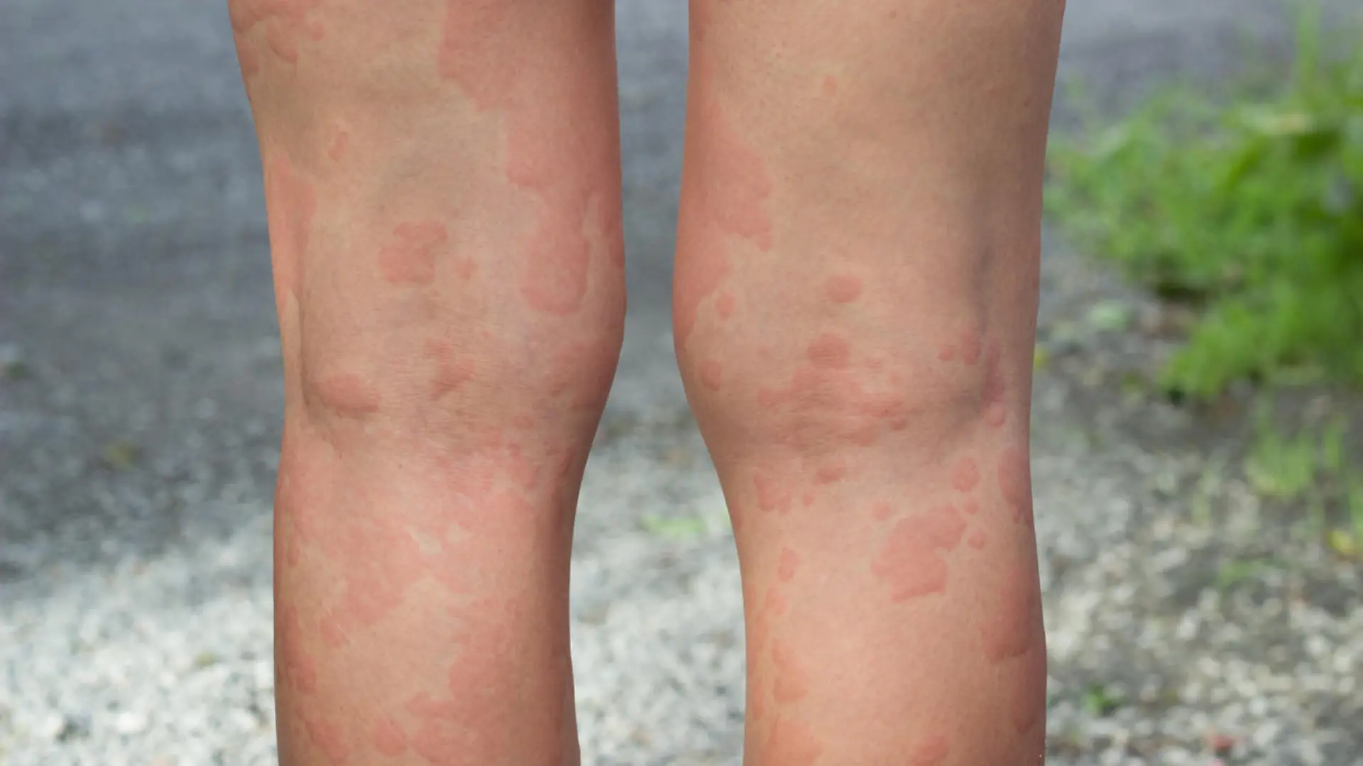 skin allergies, legs skin women.skin allergies, legs women.