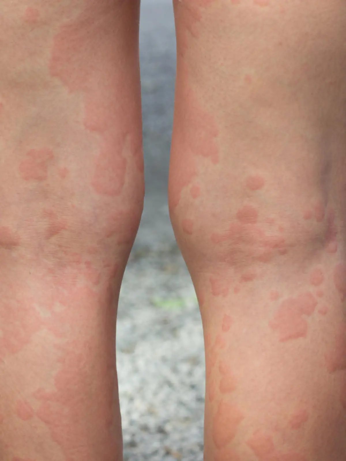 skin allergies, legs skin women.skin allergies, legs women.