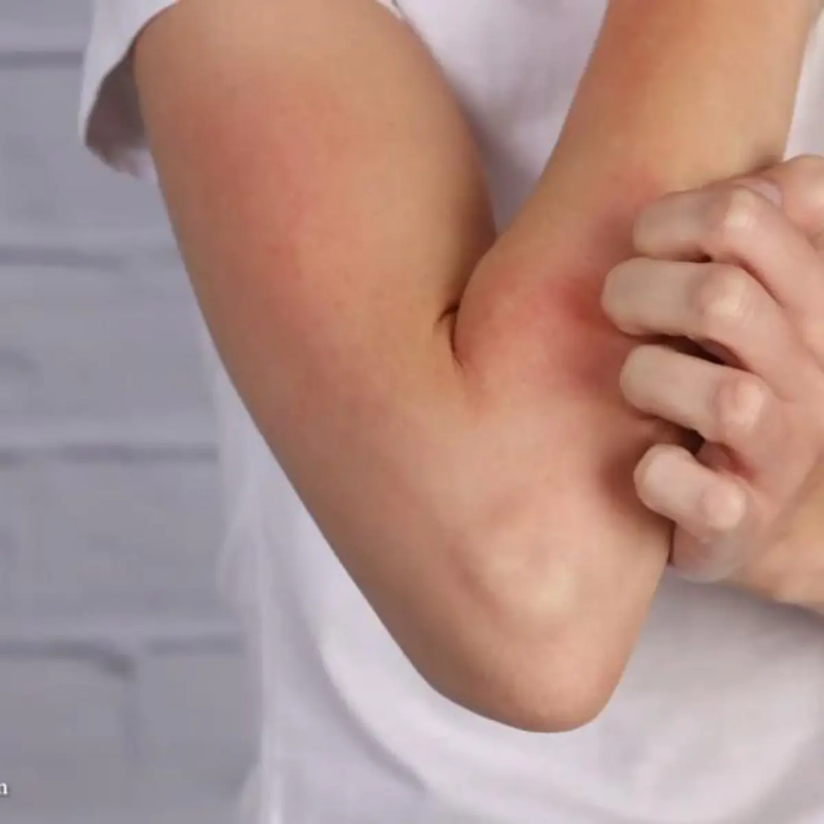 Neurodermitis Logo von Neurodermitis