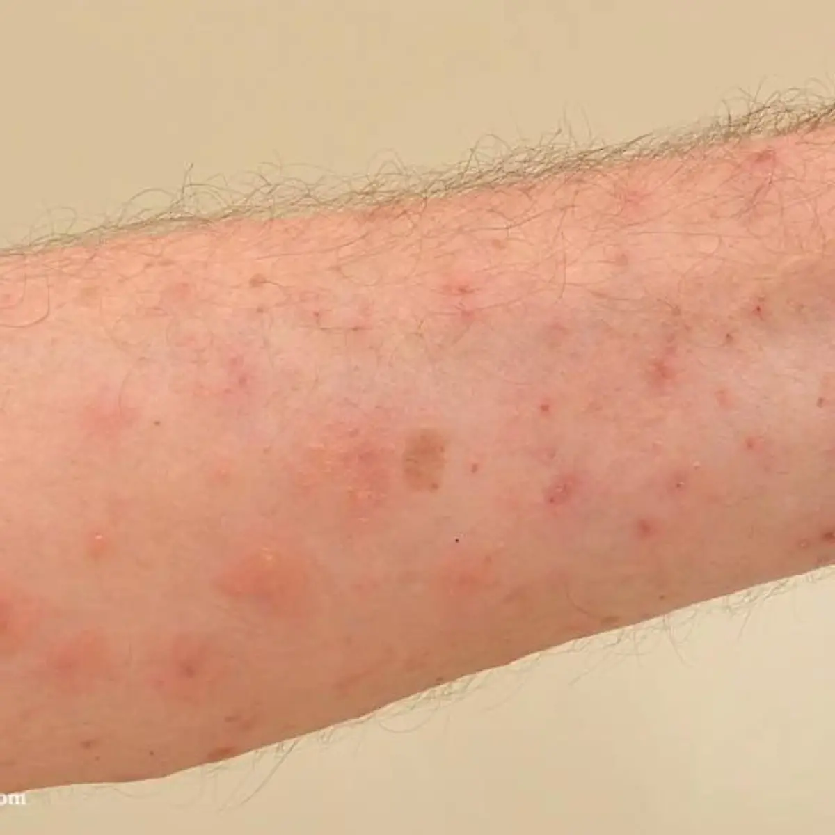 Krätze (Skabies) Logo von Krätze (Skabies)