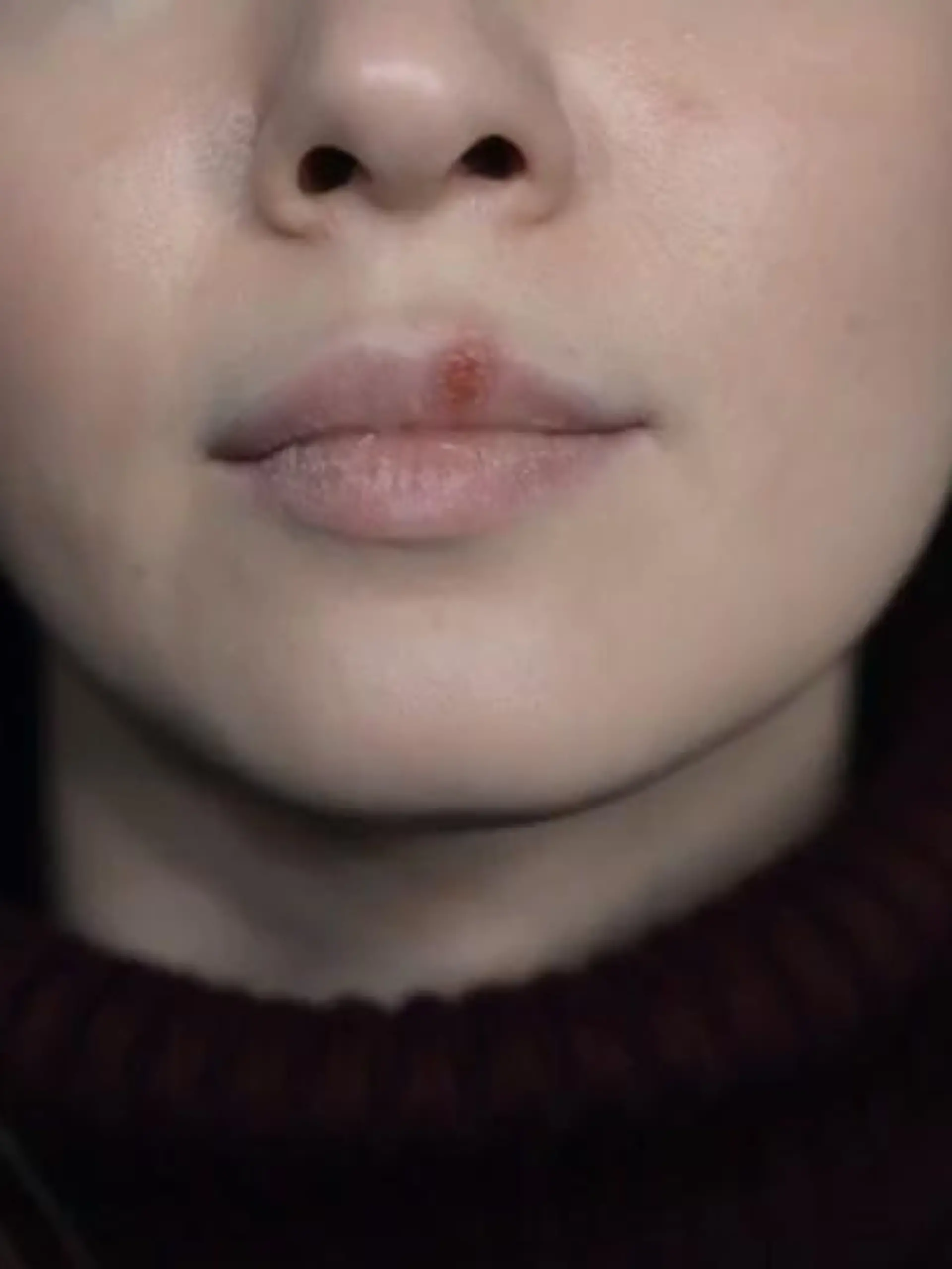 Bild zu: "Herpes"
