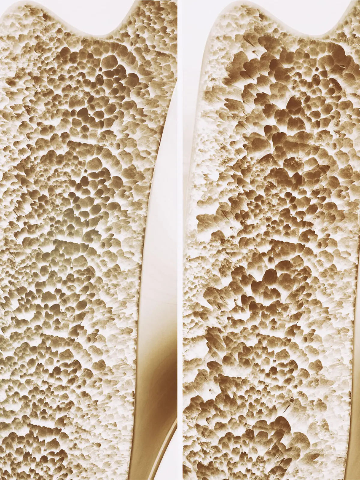 Osteoporosis 4 stages in one picture - 3d rendering