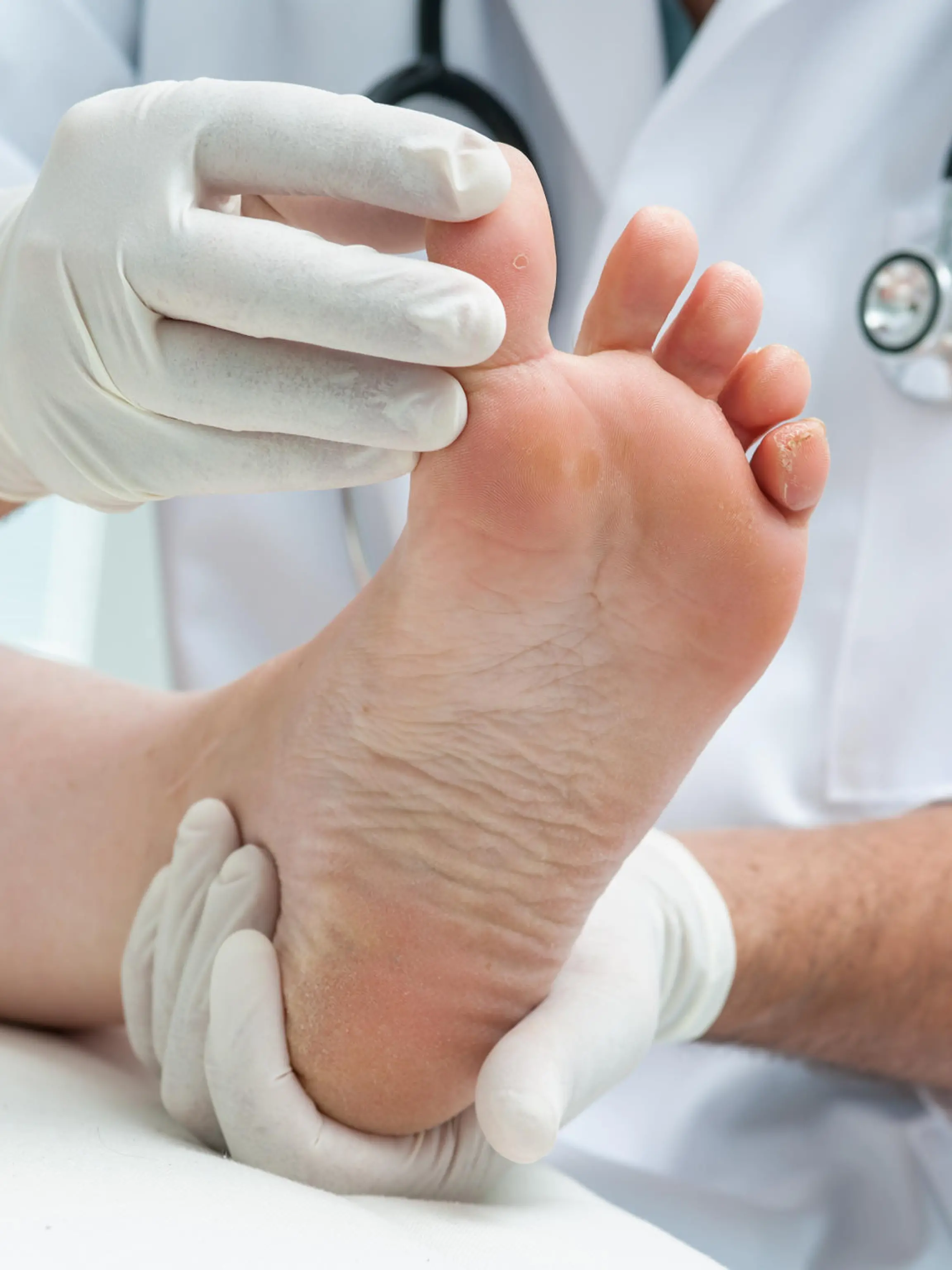 Doctor dermatologist examines the foot on the presence of athlete's foot