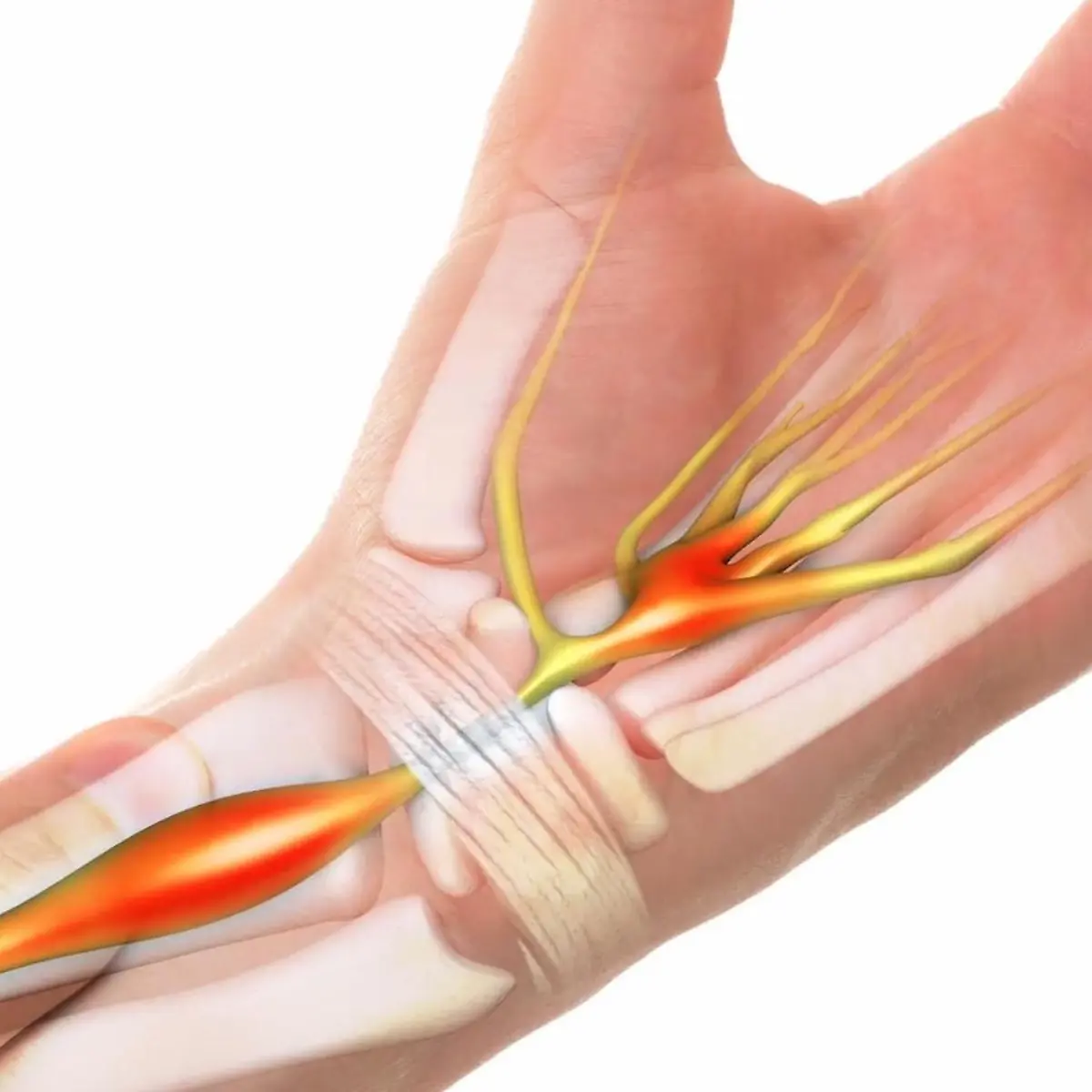 Karpaltunnelsyndrom Logo von Karpaltunnelsyndrom