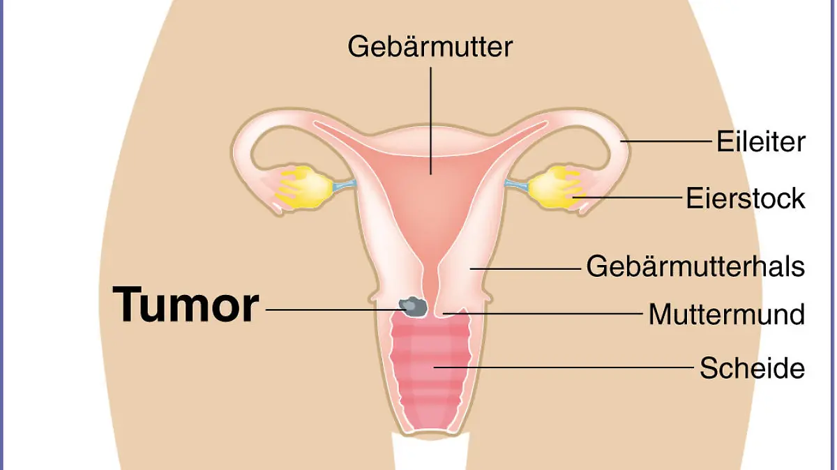 Zum Themendienst-Bericht "Früherkennung von Gebärmutterhalskrebs: Wann lohnt ein HPV-Test?" von Arnd Petry vom 26. März 2014: Humane Papillomviren können die Zellen in der Gebärmutterschleimhaut so verändern, dass im Gebärmutterhals ein Tumor entsteht. (Die Veröffentlichung ist für dpa-Themendienst-Bezieher honorarfrei.)