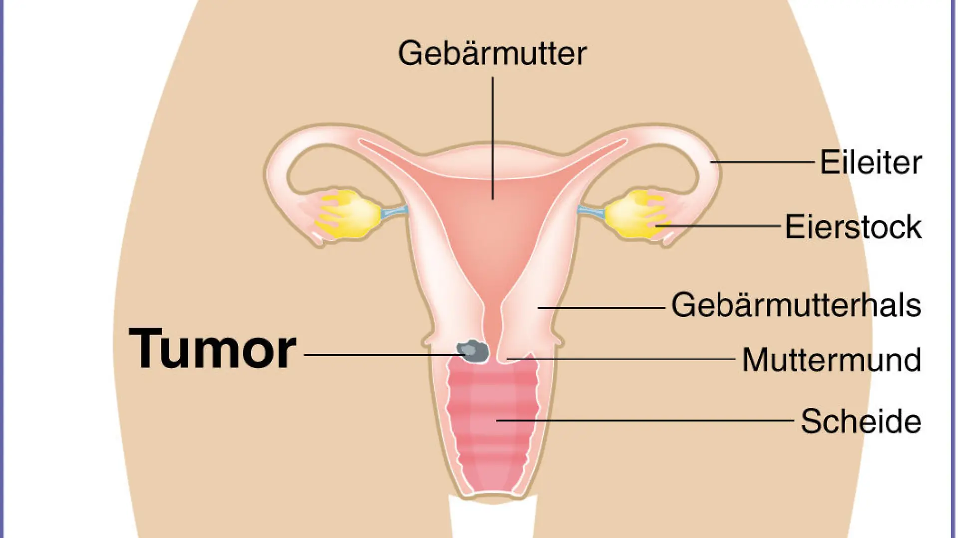 Zum Themendienst-Bericht "Früherkennung von Gebärmutterhalskrebs: Wann lohnt ein HPV-Test?" von Arnd Petry vom 26. März 2014: Humane Papillomviren können die Zellen in der Gebärmutterschleimhaut so verändern, dass im Gebärmutterhals ein Tumor entsteht. (Die Veröffentlichung ist für dpa-Themendienst-Bezieher honorarfrei.)
